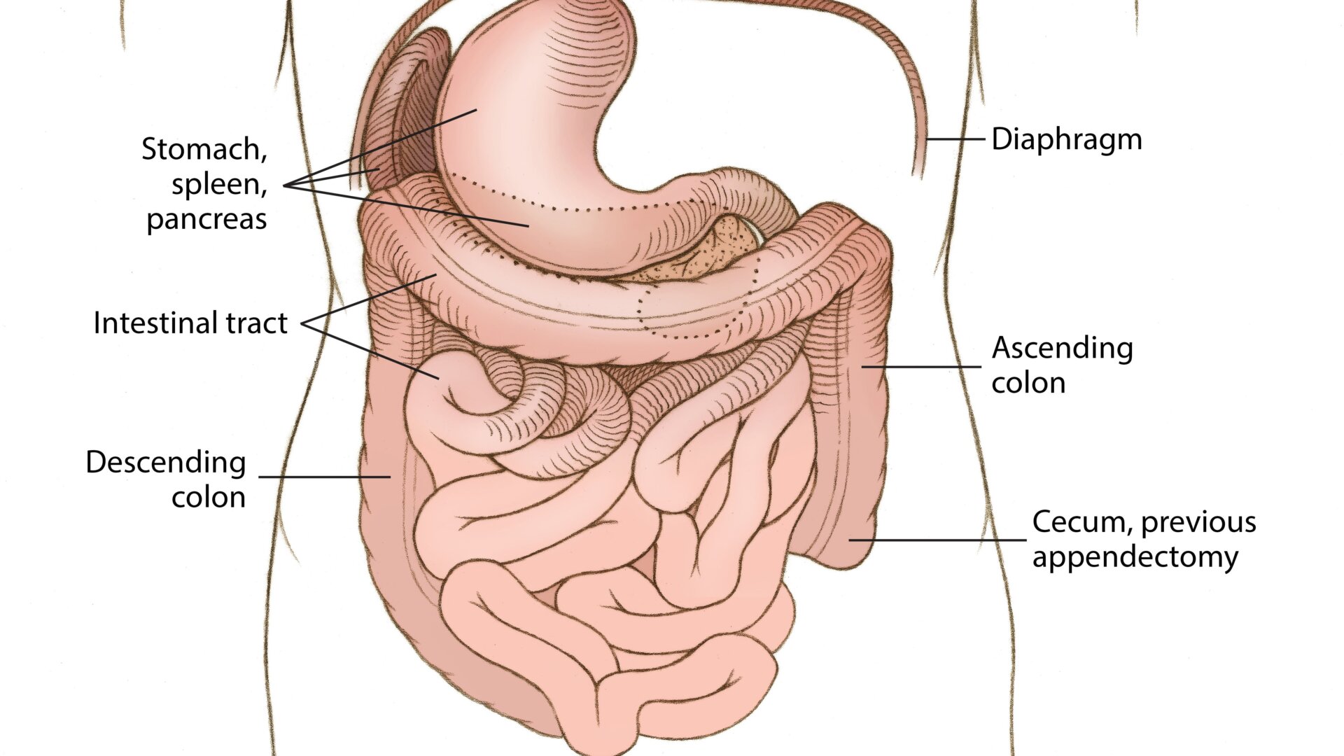An illustration of the woman’s rare condition, situs inversus with levocardia