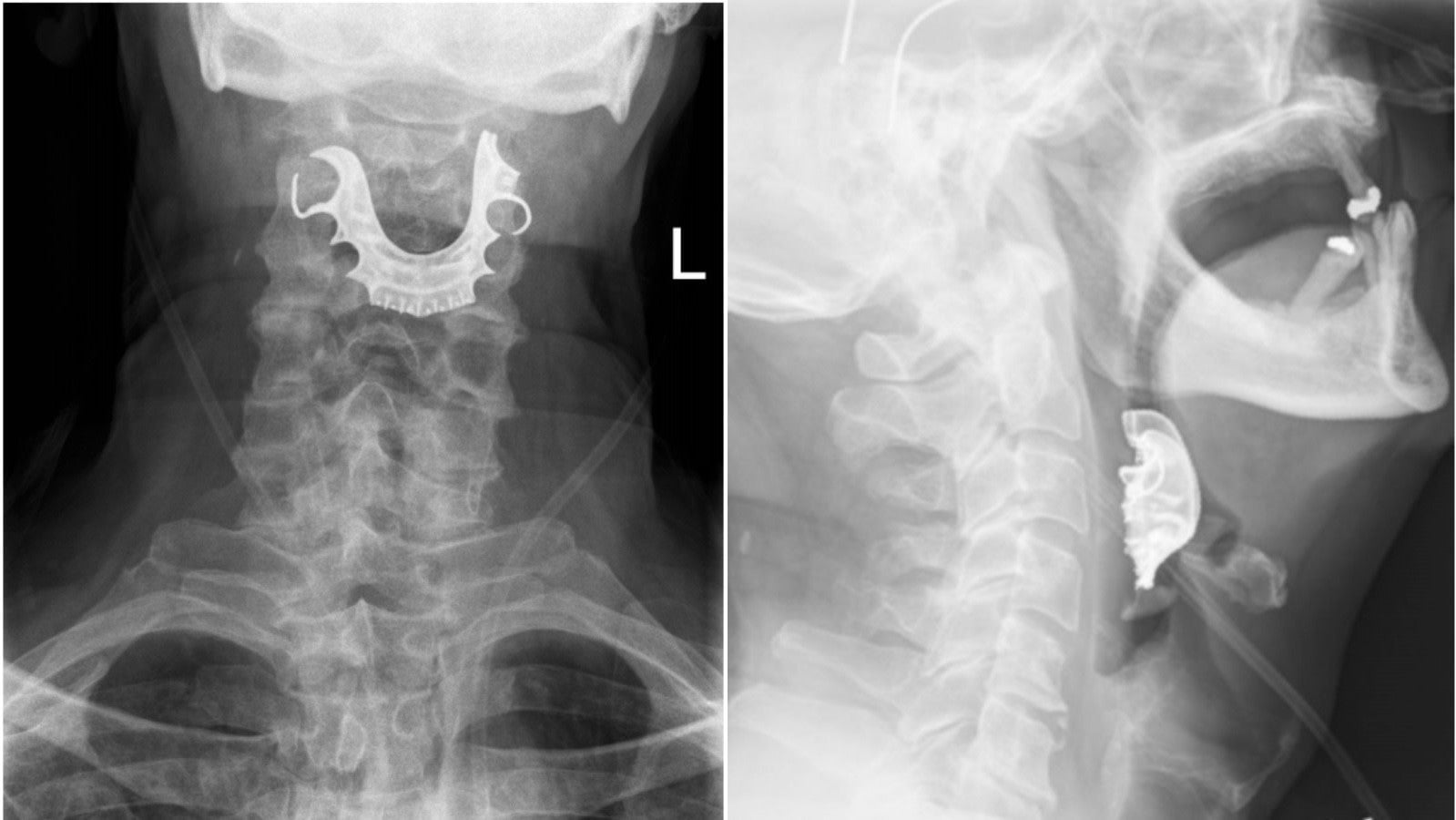 X-ray images of the dentures.