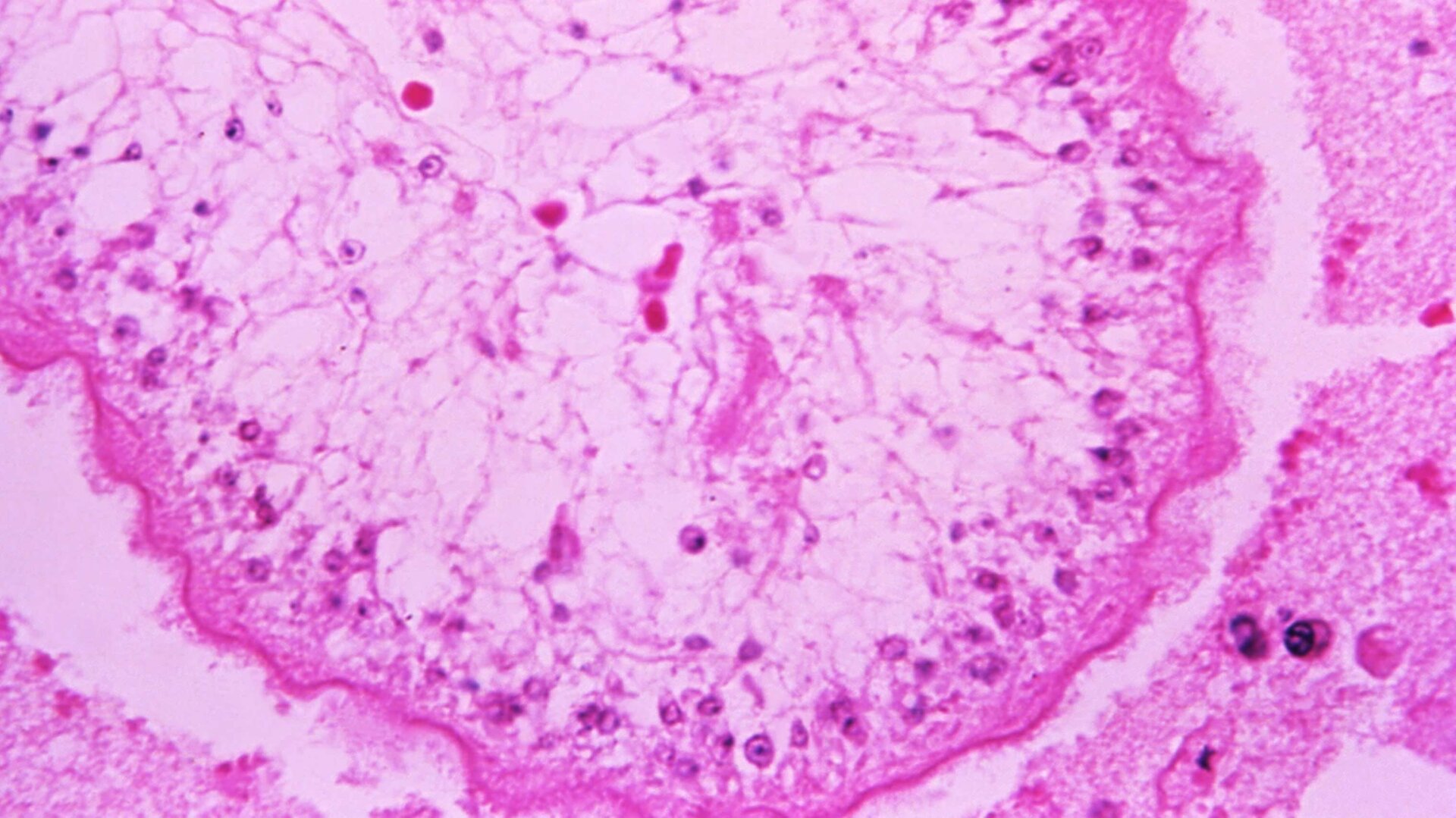 A photomicrograph of a human brain tissue specimen infected with larval cysts of the pork tapeworm (Taenia solium)