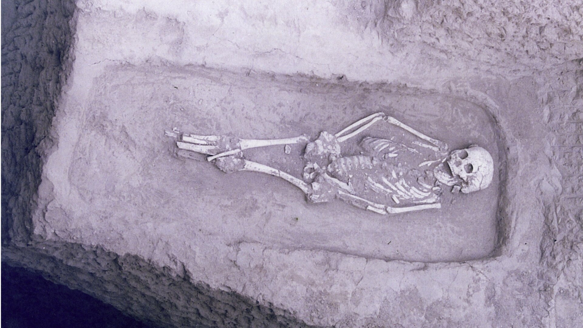The 5,000-year-old skeleton, designated M53, with physical dysplasia.
