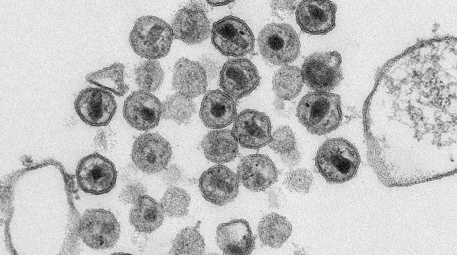 HIV viral particles under an electron microscope.