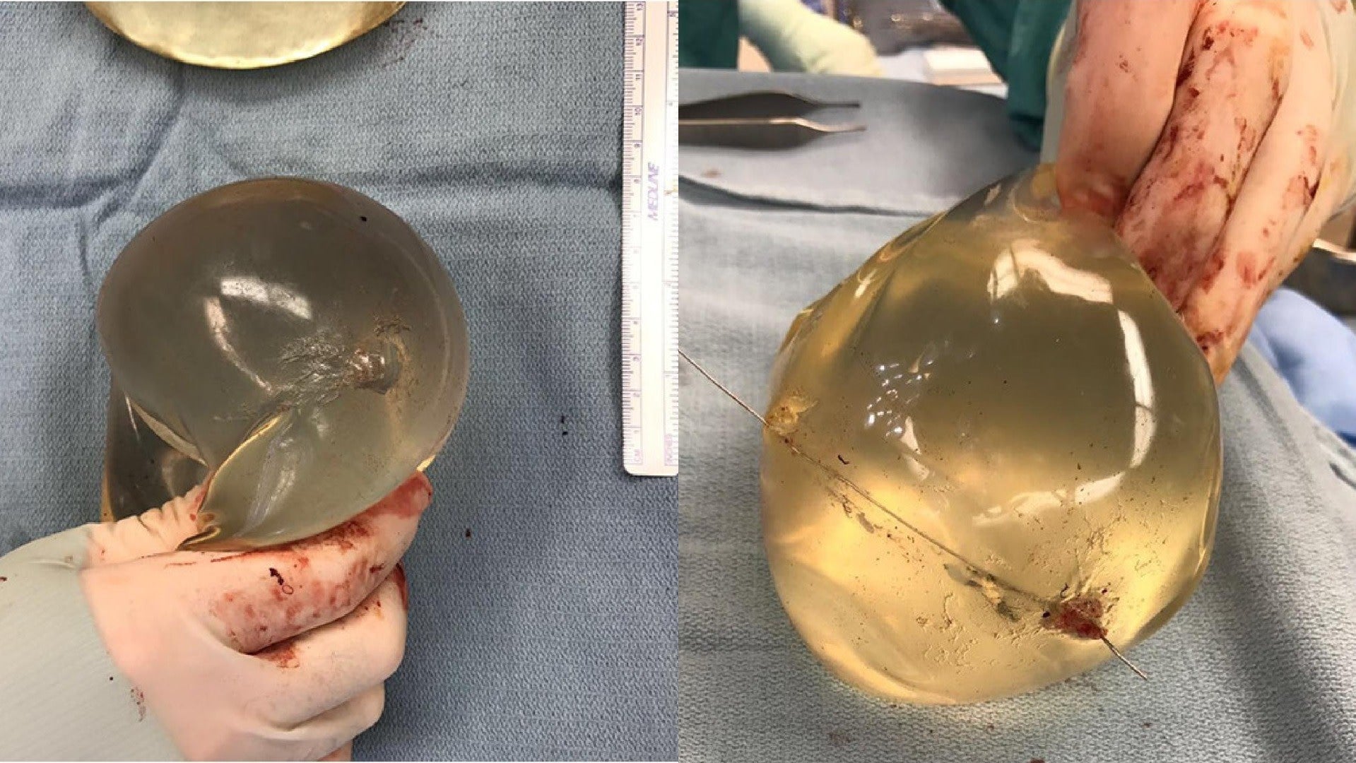 The woman’s right and left breast implants. Note the bullet tracts that can be seen in each.