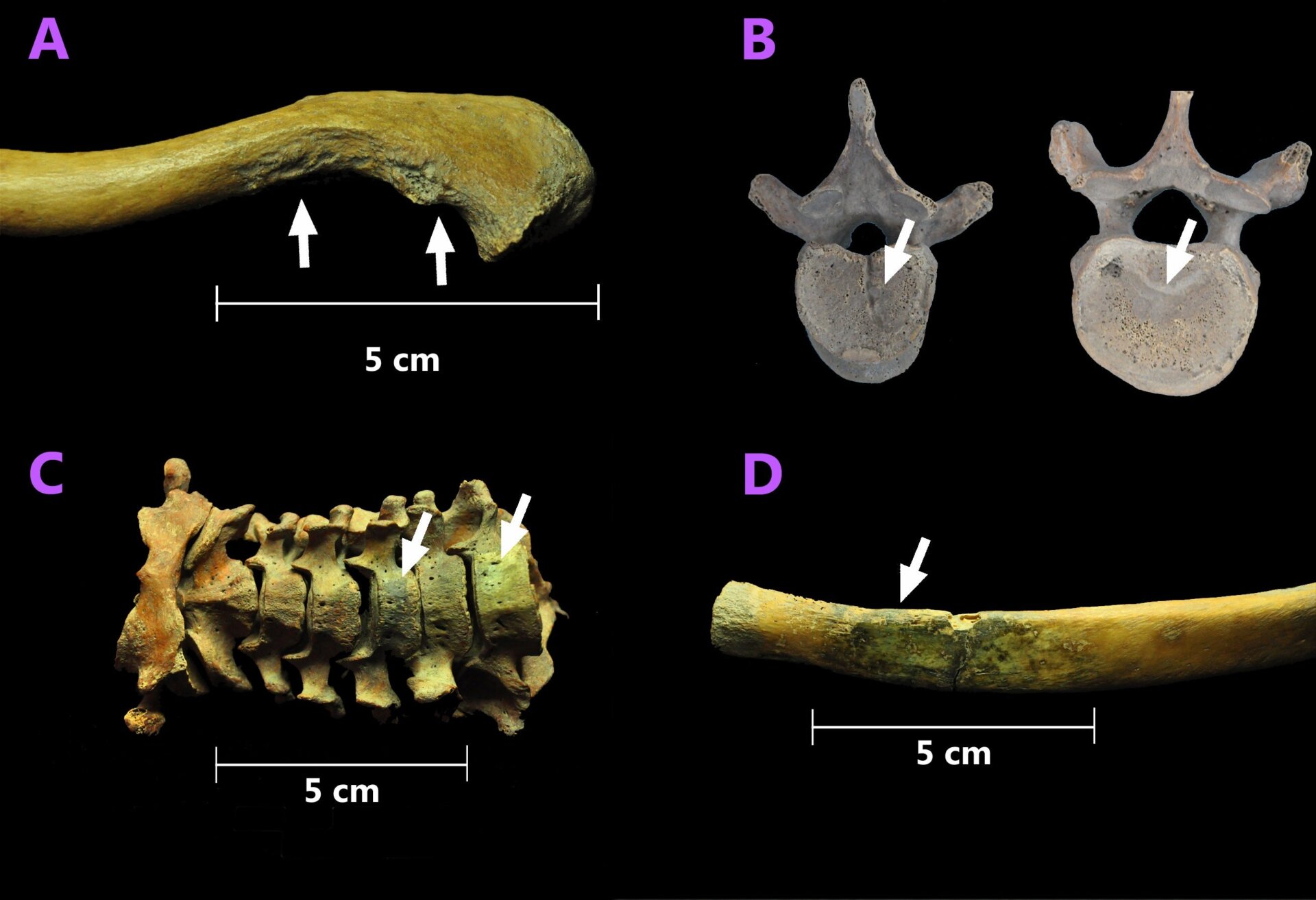 Joint and bone damage found on the skeletal remains: (A) extensive bone wear, (B) signs of hernia on a vertebrae, (C and D) greenish coloration as evidence of a copper bullet.