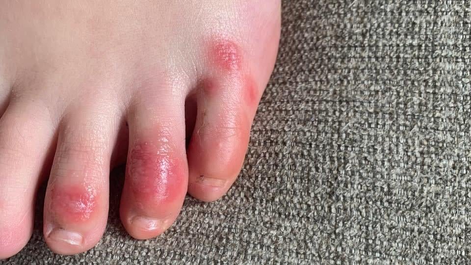 A teenage patient’s foot soon after the start of her symptoms.