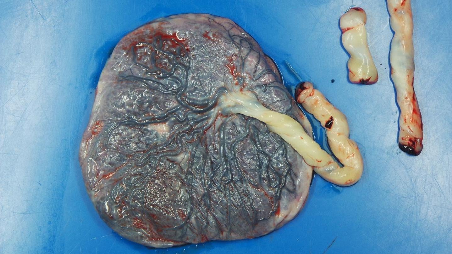 A placenta taken from a women who contracted covid-19. Researchers found that infected women had a greater risk of blood flow problems in their placenta, which could be harmful to their pregnancy. 