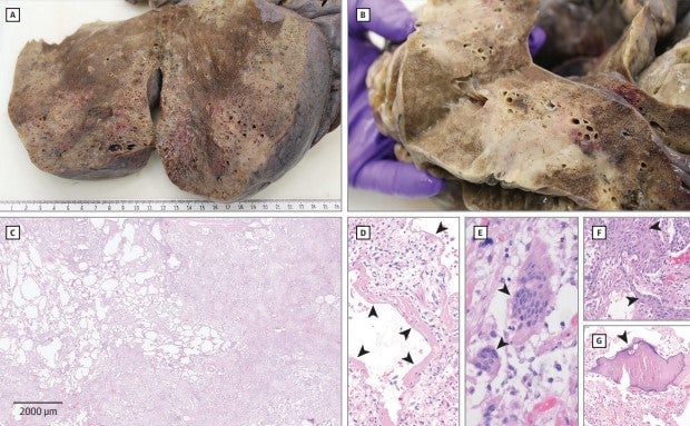 The lungs of someone who died from covid-19, with the images from the bottom taken under a microscope.