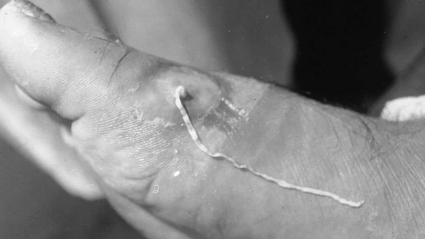 A person’s foot being infested by the guinea worm, date unknown.