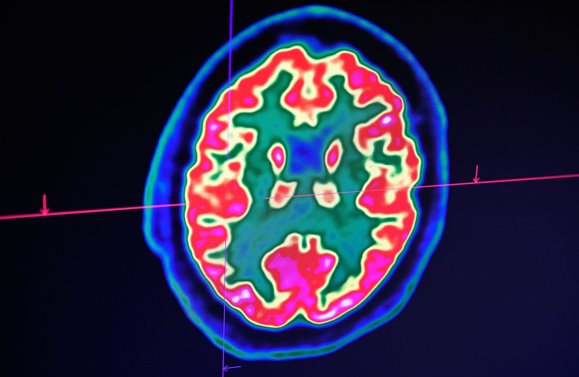 A picture of a human brain taken by a positron emission tomography scanner, also called a PET scan.