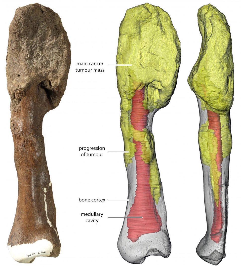 The main tumor mass is at the top of the bone, and can be seen on the 3D reconstruction in yellow; red gray is the normal bone and red denotes the medullary cavity.