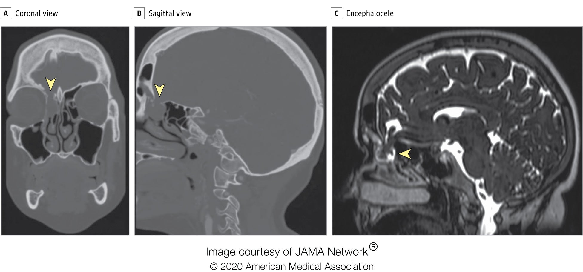 A CT scan of the woman’s brain taken in 2017 did reveal her rare birth defect, but it wasn’t noticed until after a nasal swab test for covid-19 likely injured it and caused spinal fluid to leak out. 