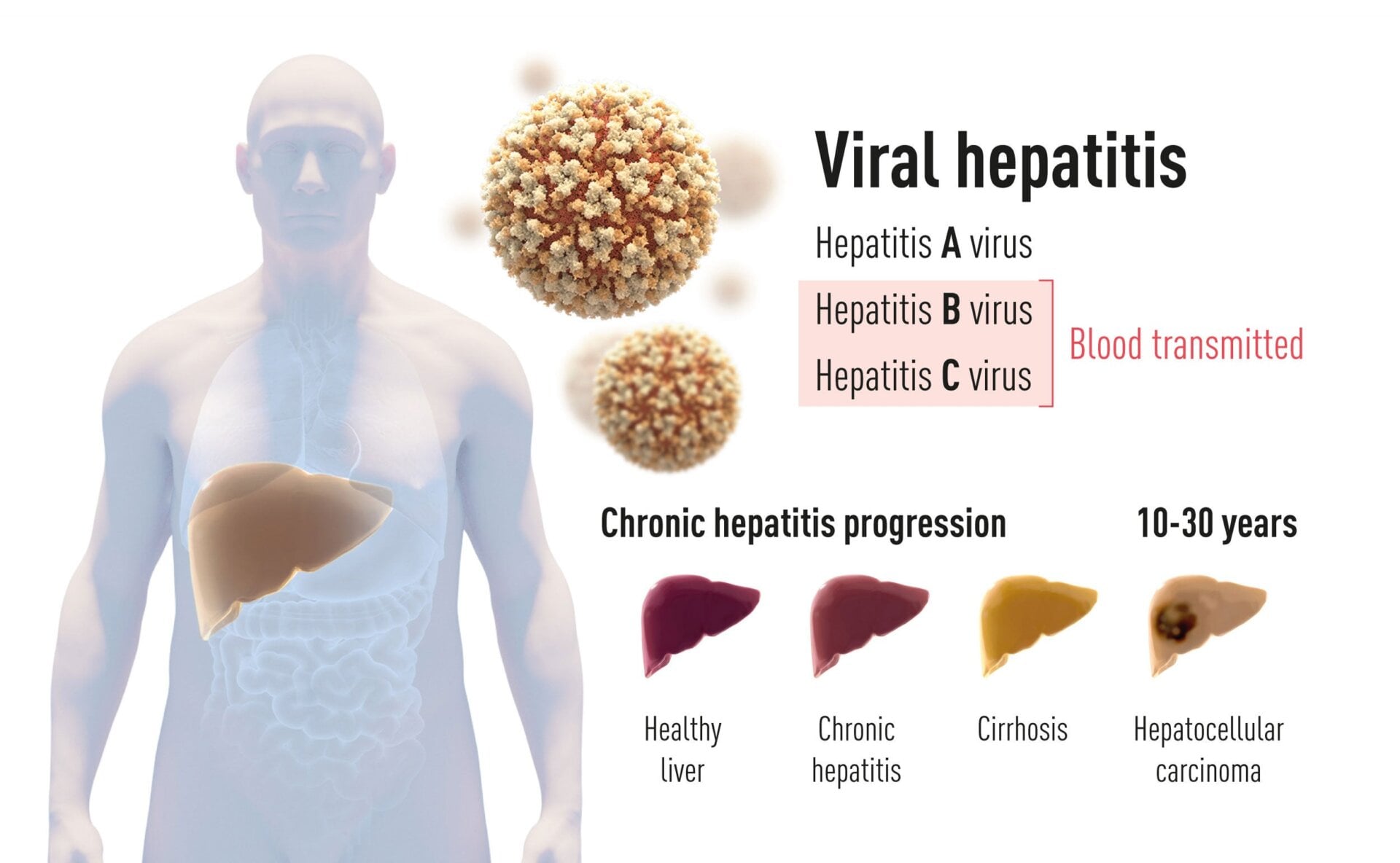 There are two main forms of hepatitis virus, one that spreads through food and water (type A) and two kinds that are blood-borne (types B and C). 