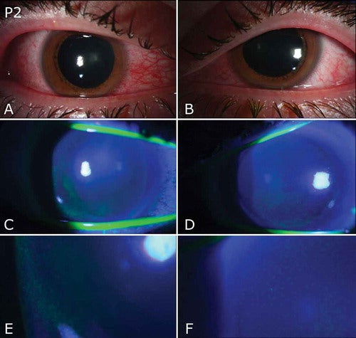 Slit-lamp photography of both eyes of one patient who developed inflamed corneas after exposure to a UV lamp.