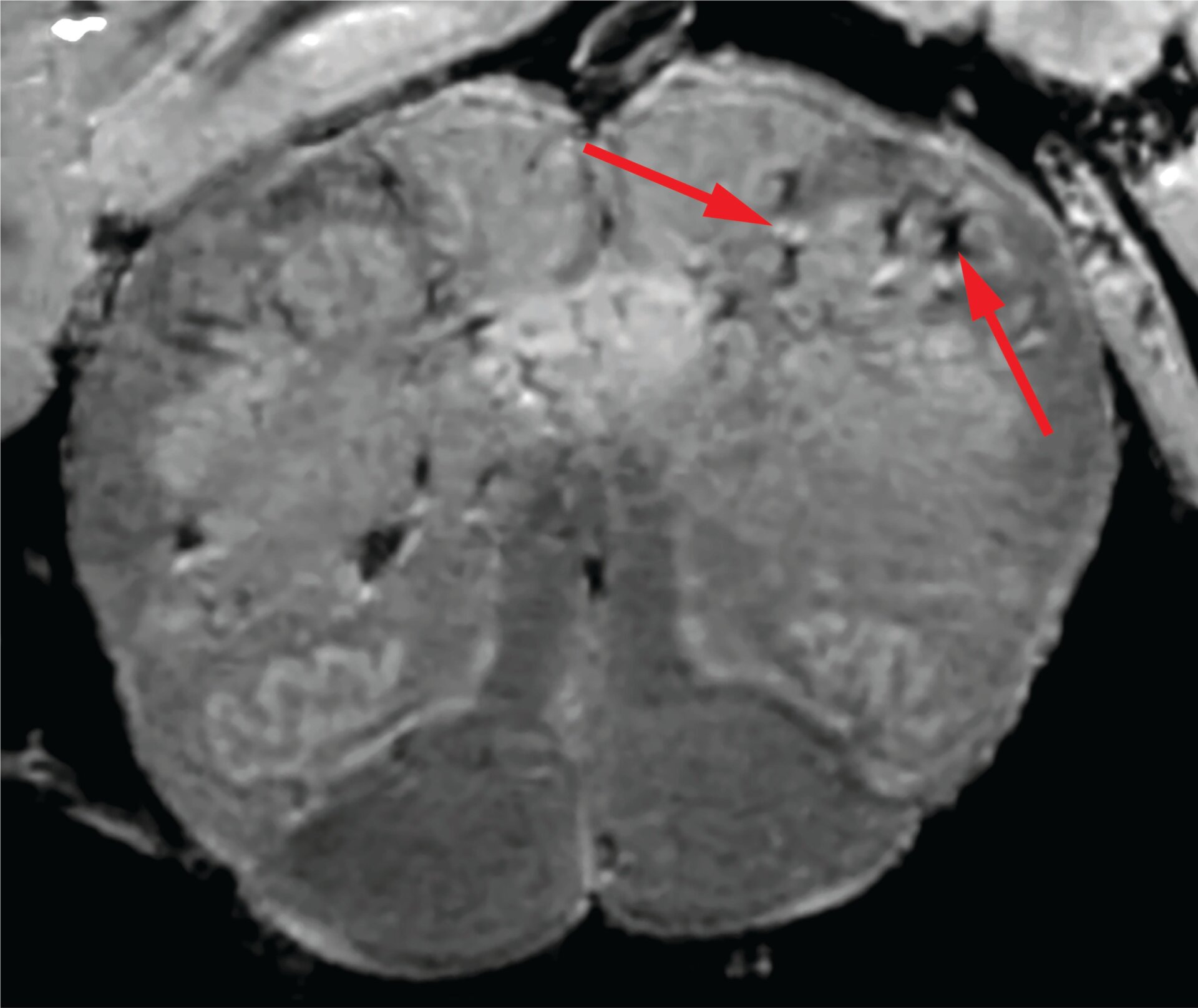 A high-resolution scan of a covid-19 patient’s brain stem. The arrows point to light and dark spots that suggest blood vessel damage.