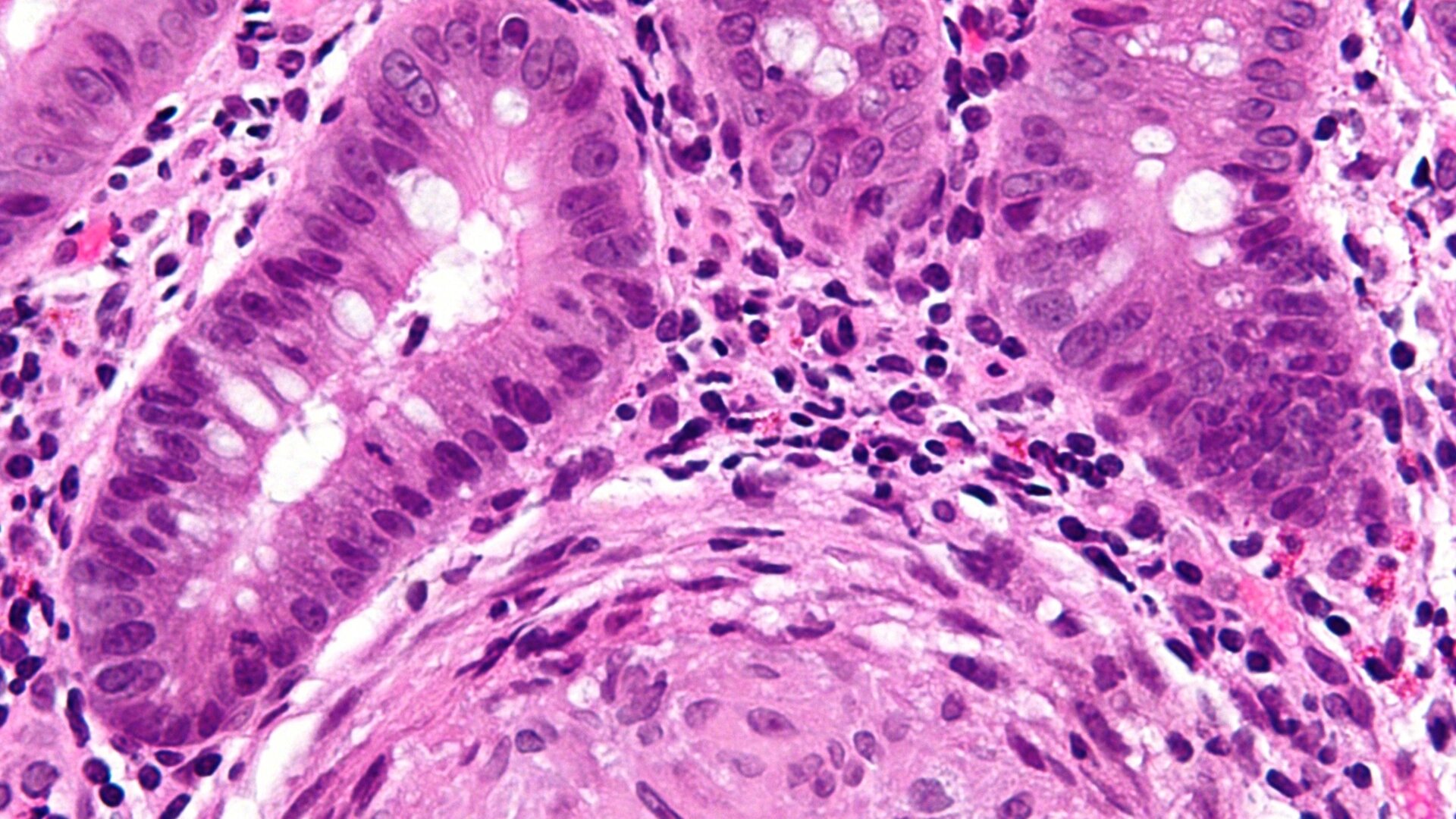 Very high magnification micrograph of Crohn’s disease.