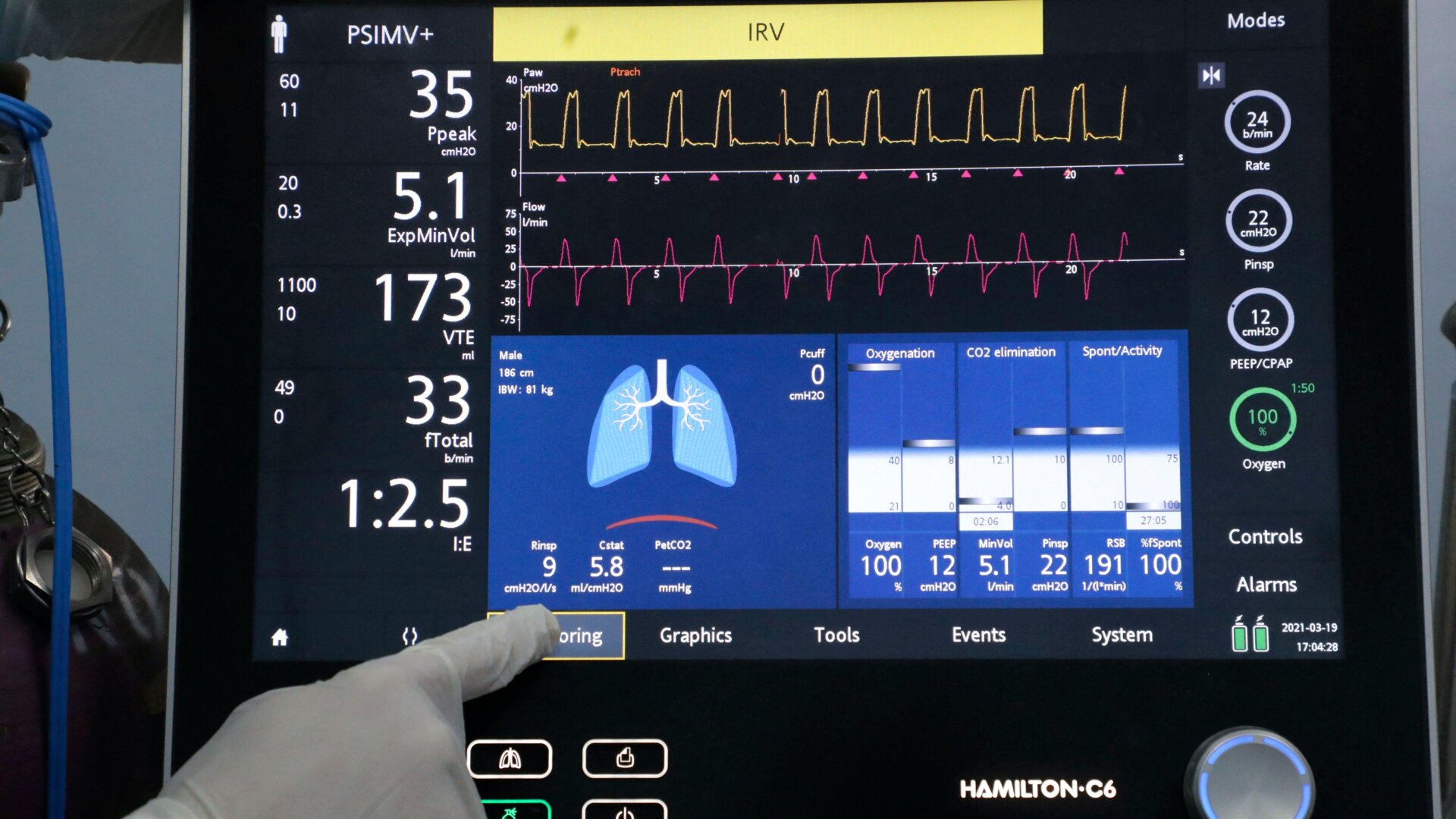 An Extracorporeal Membrane Oxygenation (ECMO) machine connected to a covid-19 patient in the intensive care unit of al-Ahli hospital in the West Bank town of Hebron on March 19, 2021.