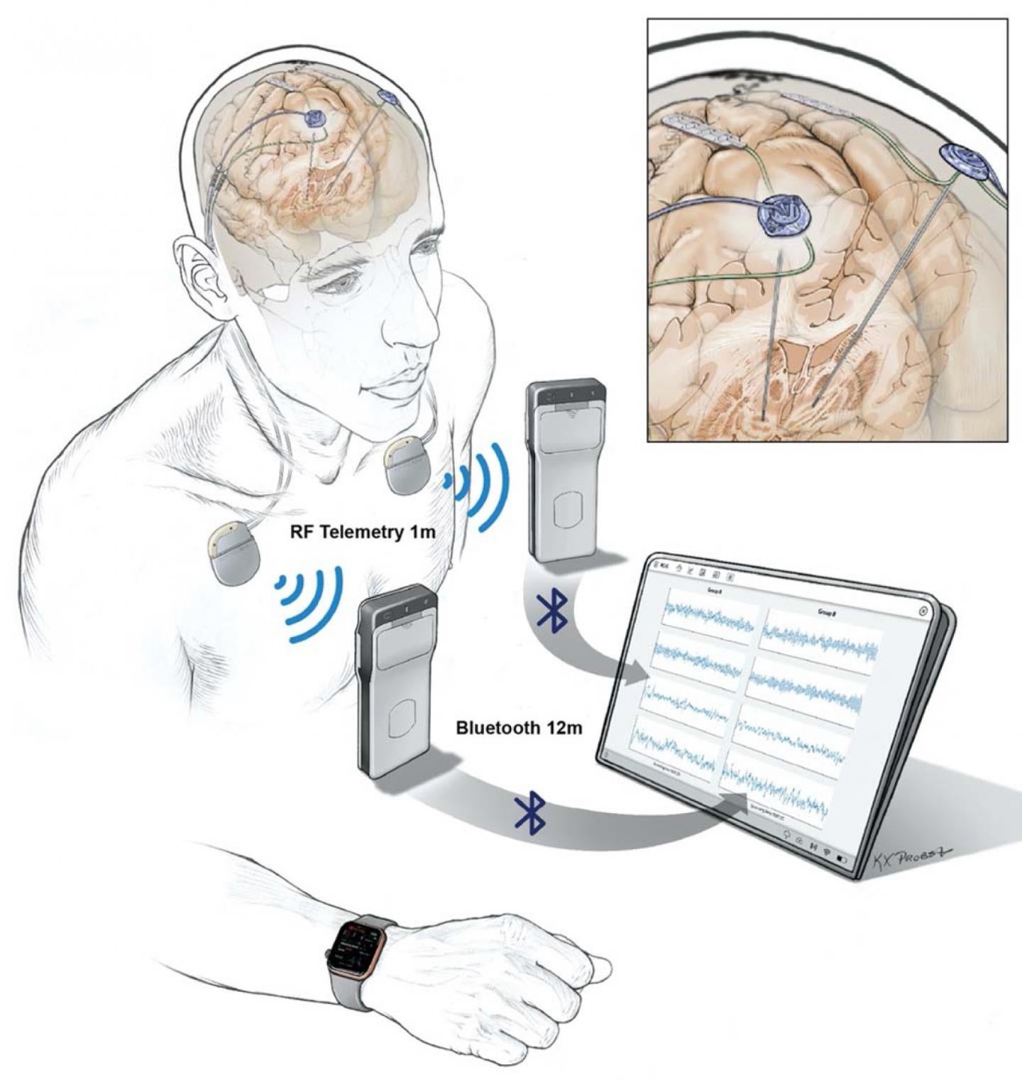 Implanted electrodes stream recorded data to a pocket-sized device worn by a patient. The data is then wirelessly transferred to a tablet and uploaded to the cloud via a HIPAA-compliant server.