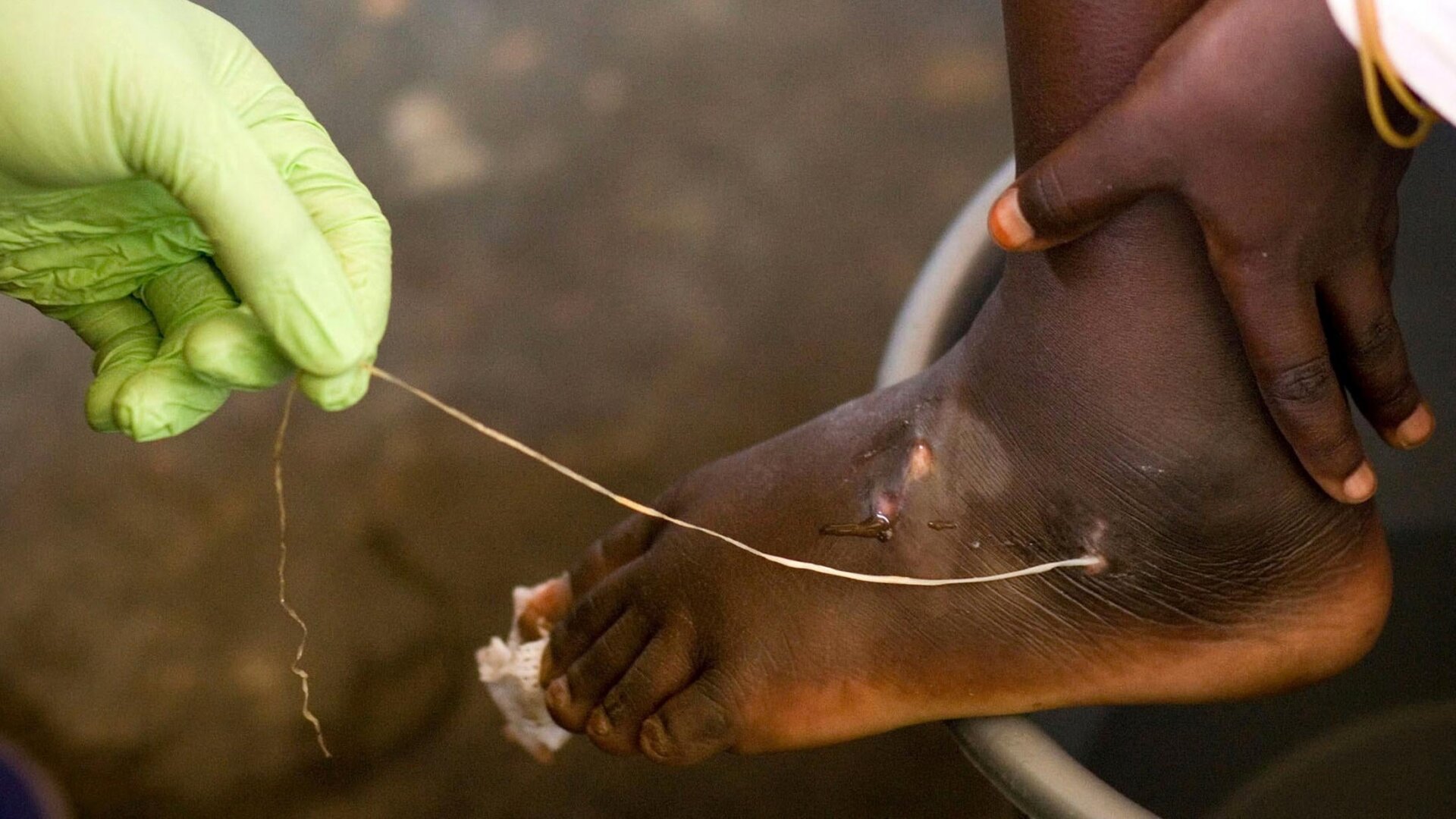 A Guinea worm being extracted from a child’s foot at a containment center in Savelugu, Ghana in a March 2007 photo. The worm found in the Vietnam case was a related species, possibly native to reptiles.