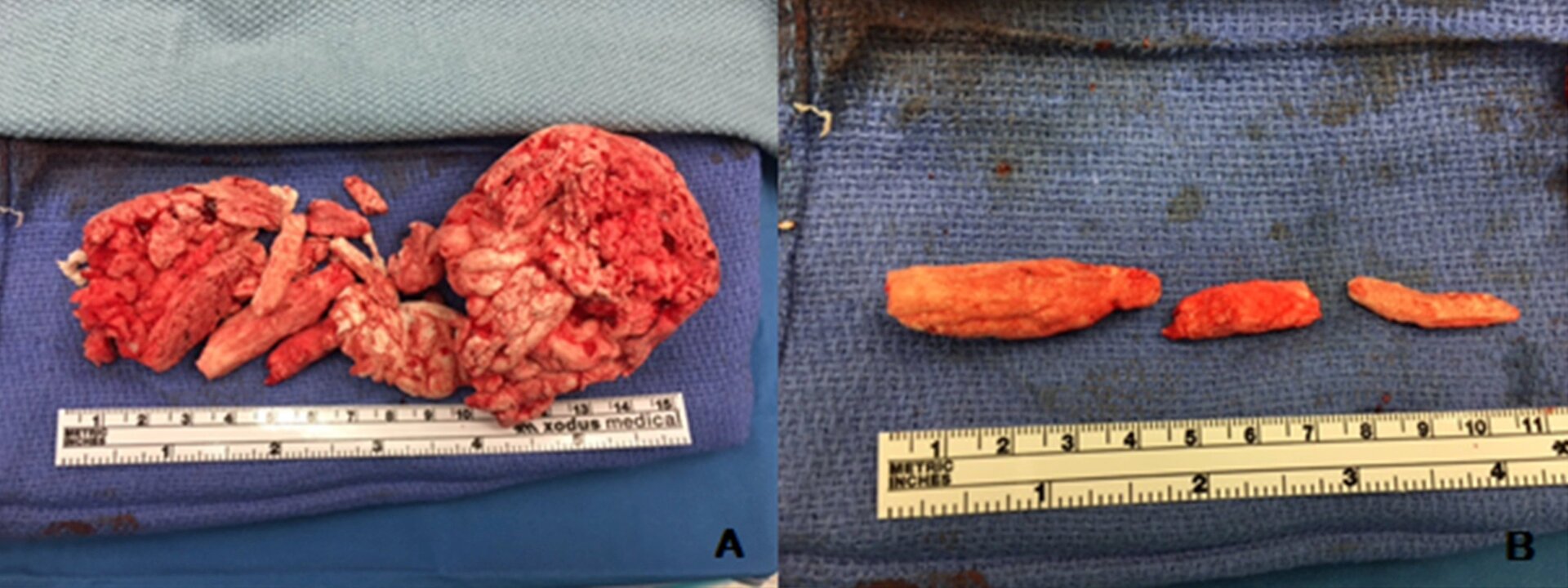 The foam removed from the man’s bladder and urethra. 