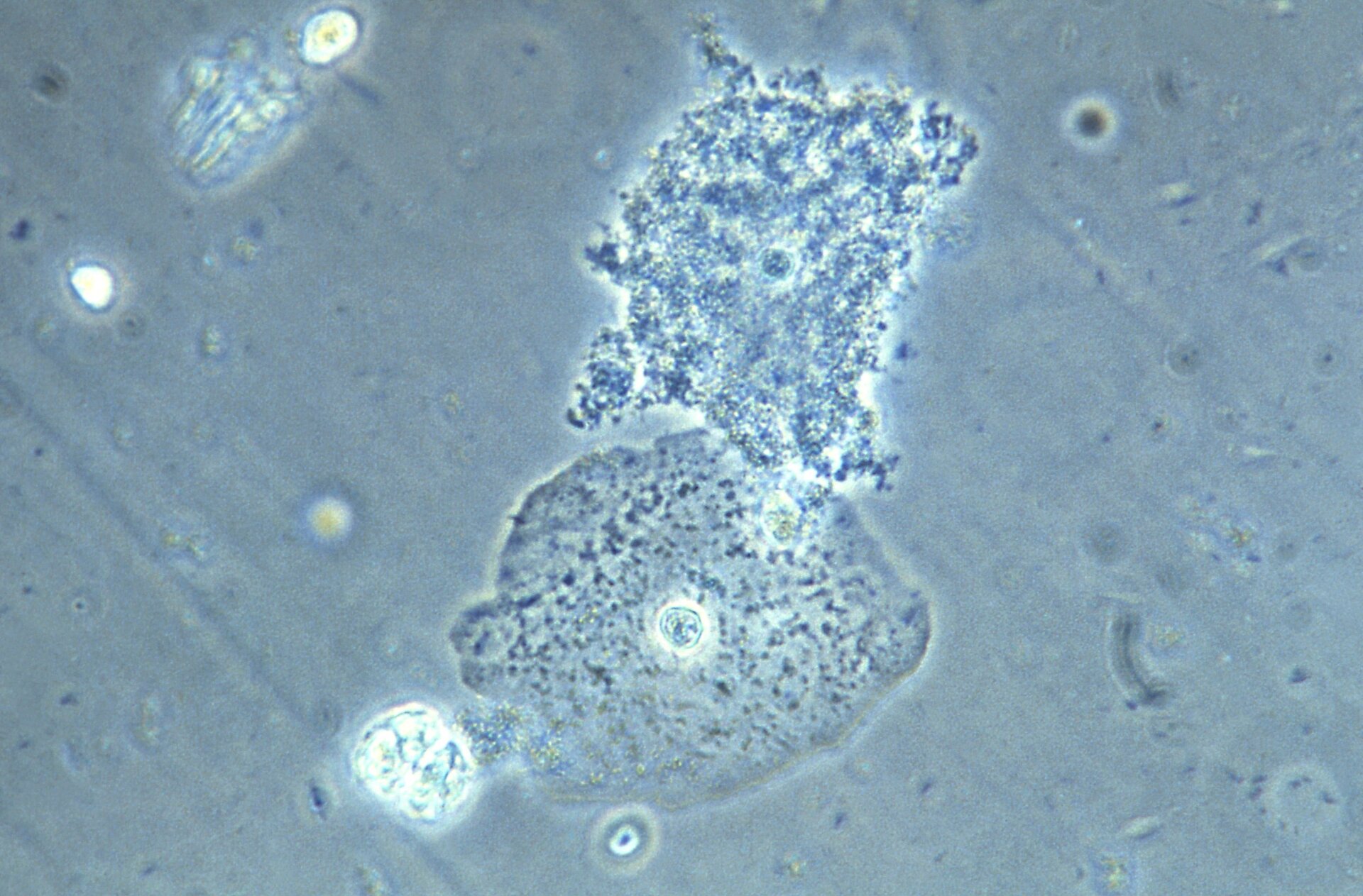 A micrograph of vaginal cells collected from someone showing signs of bacterial vaginosis.