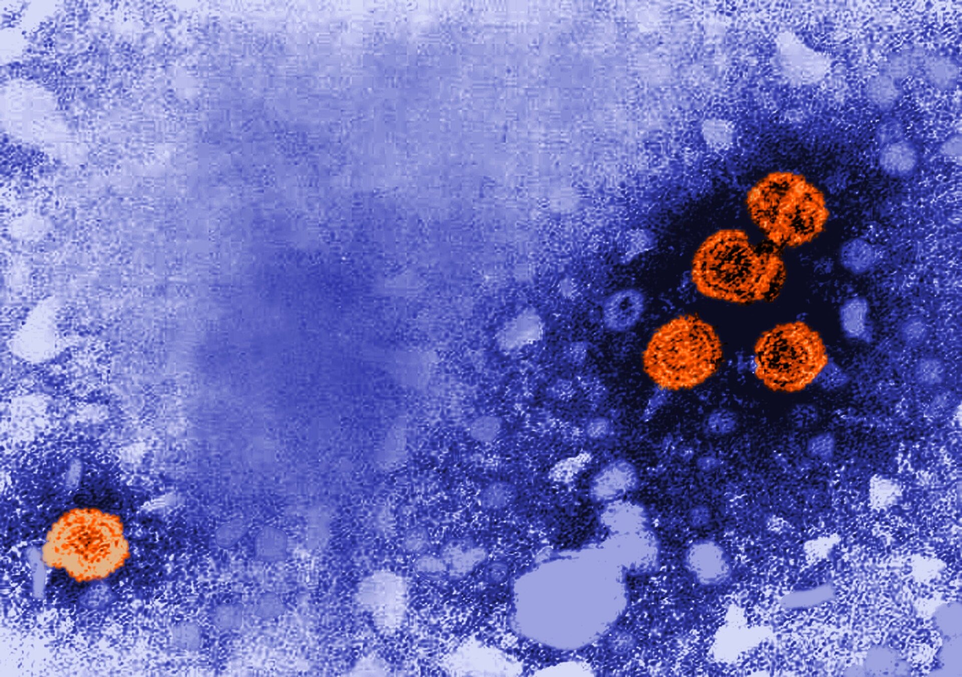 Hepatitis B particles, seen in orange under a transmission electron microscope.