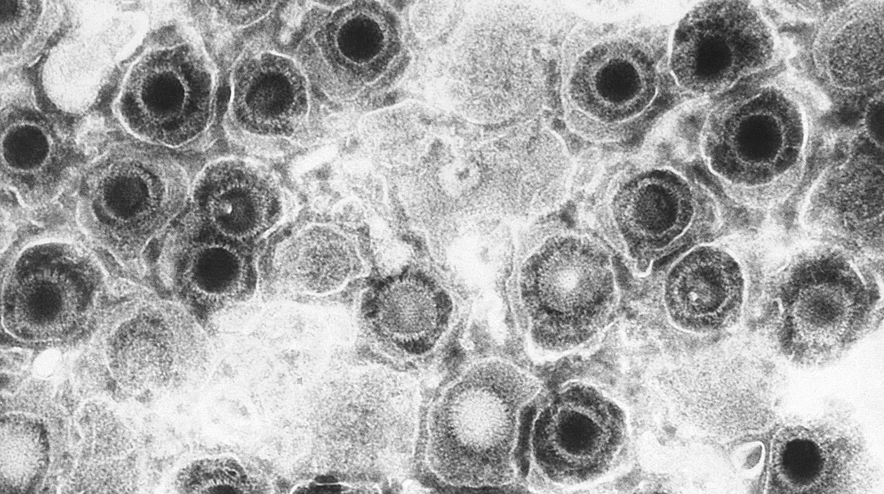 A negative-stained transmission electron microscopic (TEM) image of herpes simplex viruses.