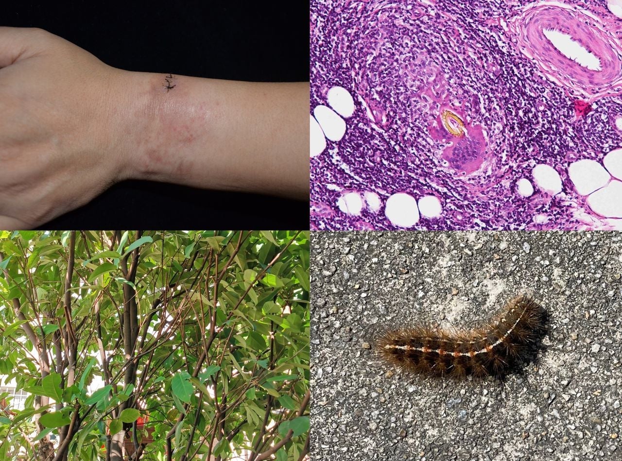 Upper left, the affected area of the man’s wrist after biopsy; bottom left: the wax apple tree in his yard; top right: an image of the caterpillar setae under a microscope; bottom right: a spongy moth caterpillar found in the man’s yard.