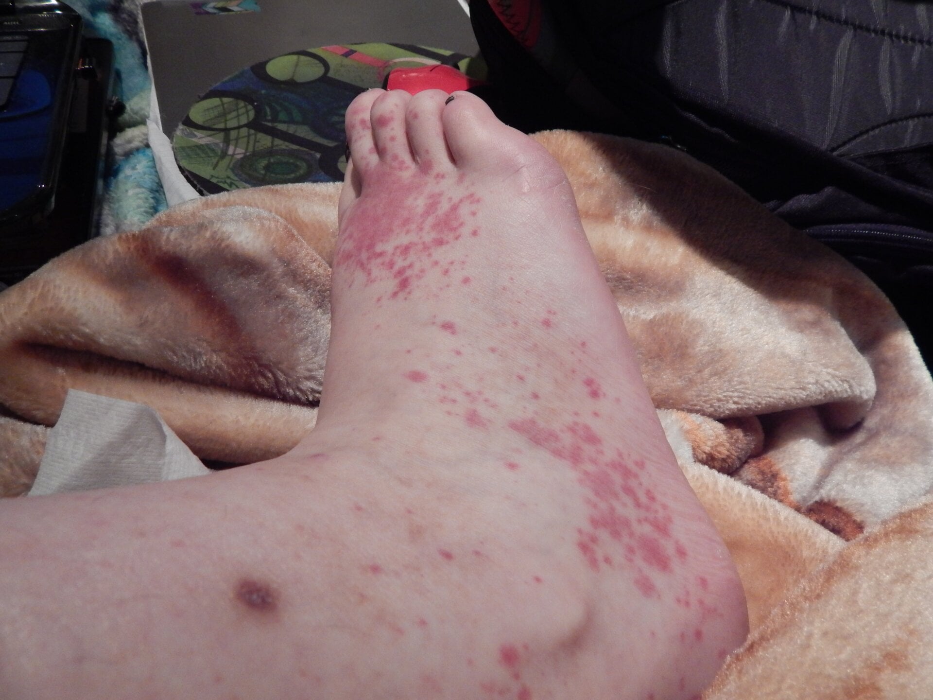Chronic hives on a person’s foot.