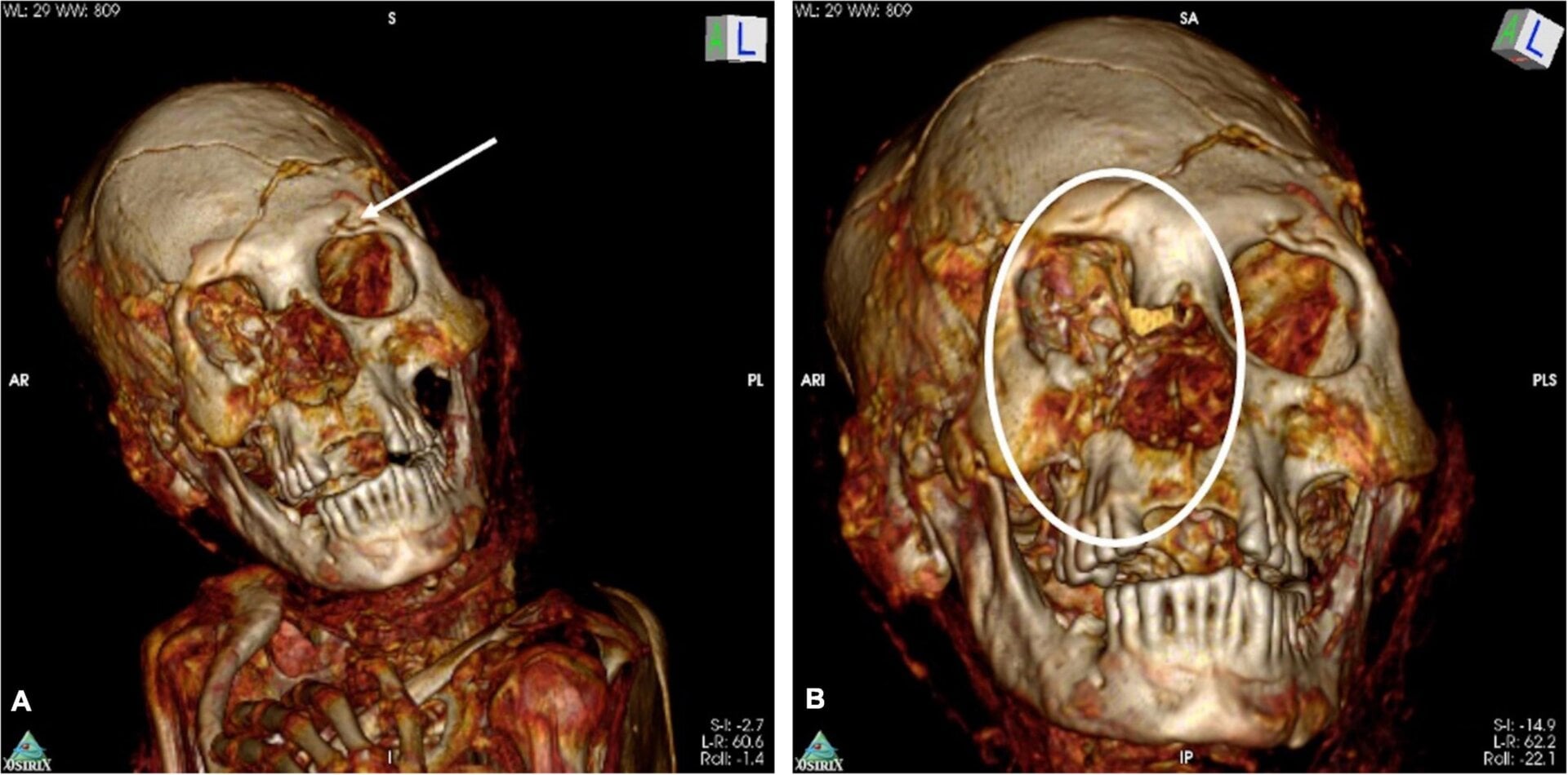 A CT scan image of the skull of one of the apparently murdered individuals, showing healed defects and lesions.