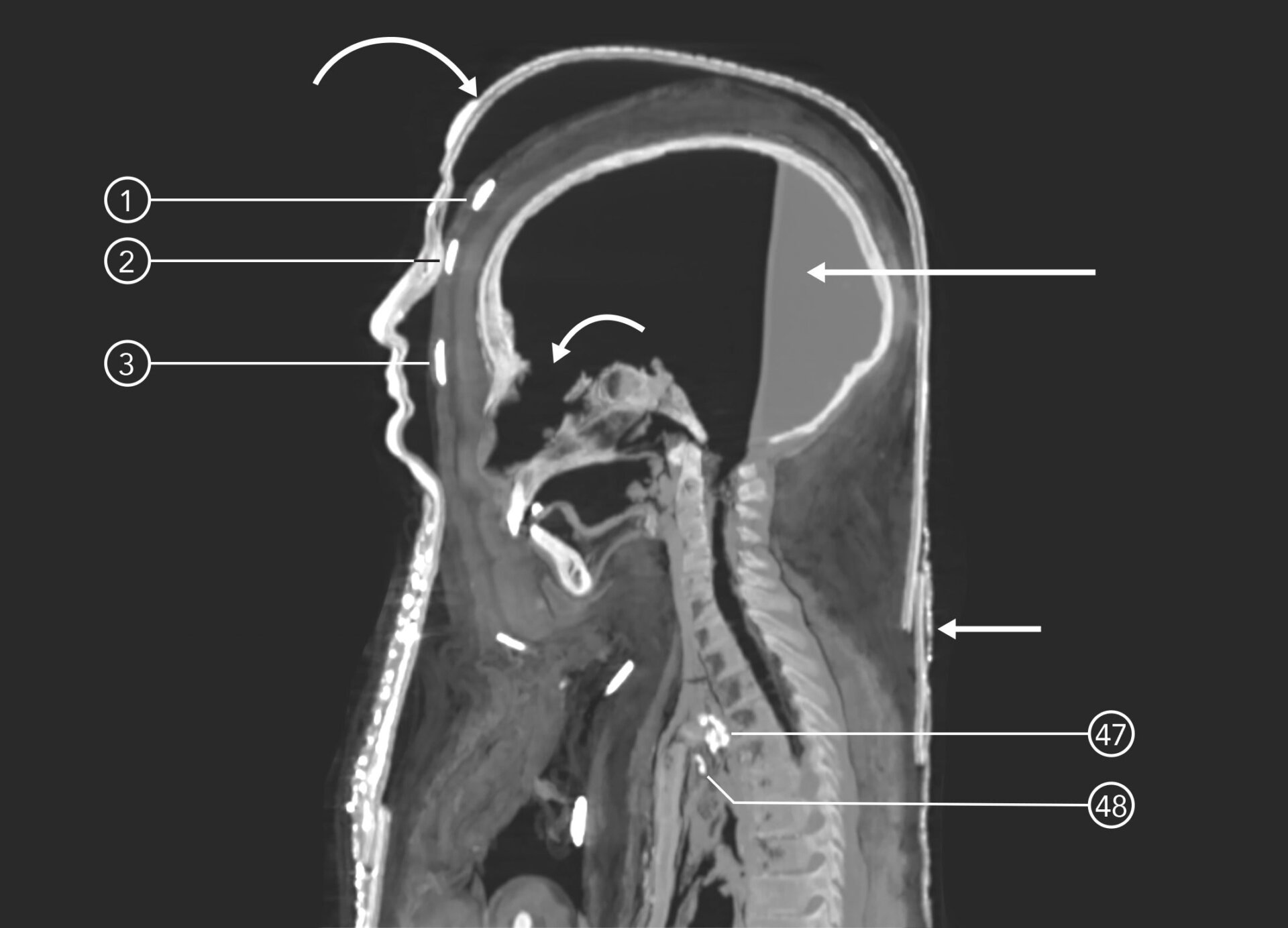 The mummy in profile reveals amulets on the mummy’s surface, interior, and solidified resin in the back of the body’s head.