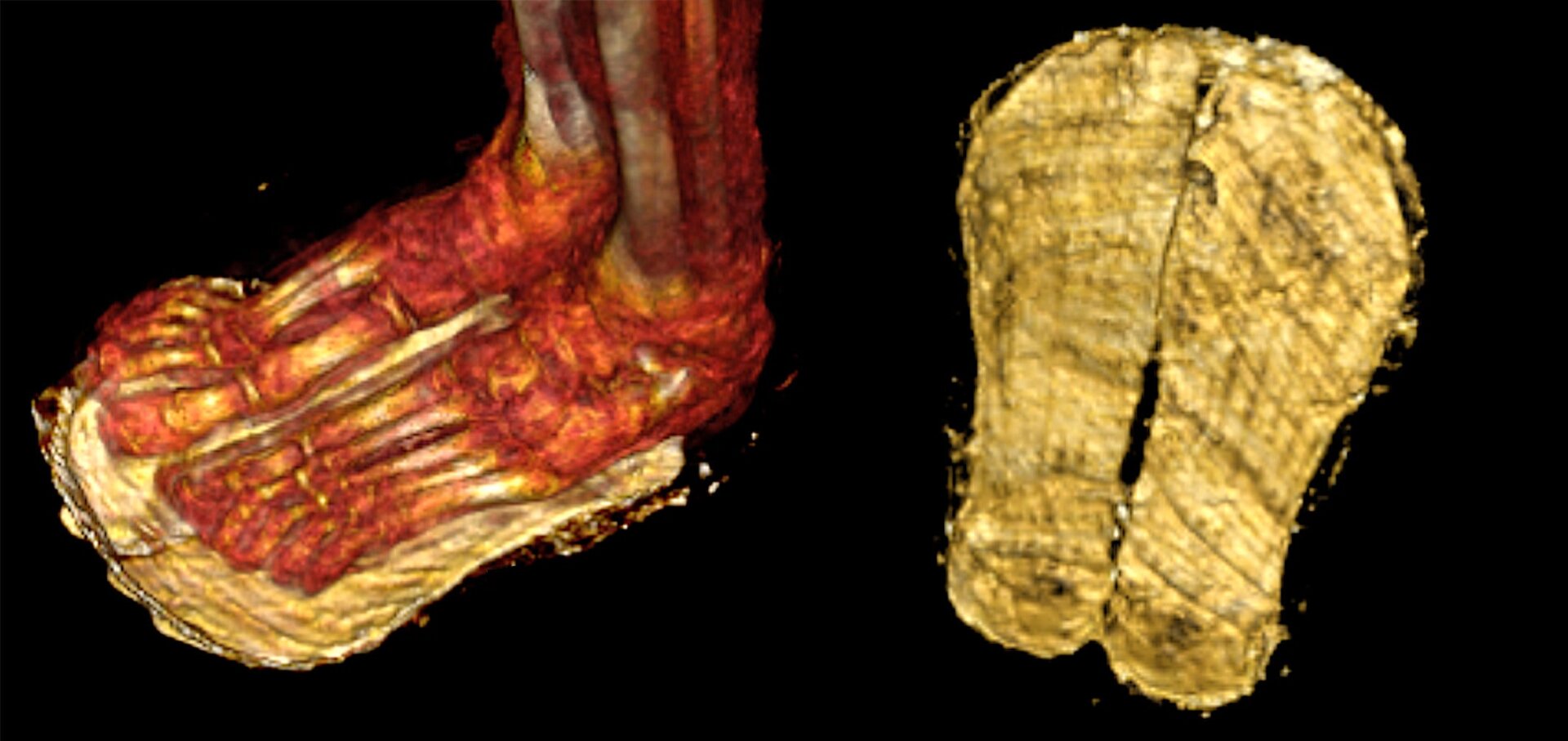 CT scans revealed sandals on the boy’s feet.