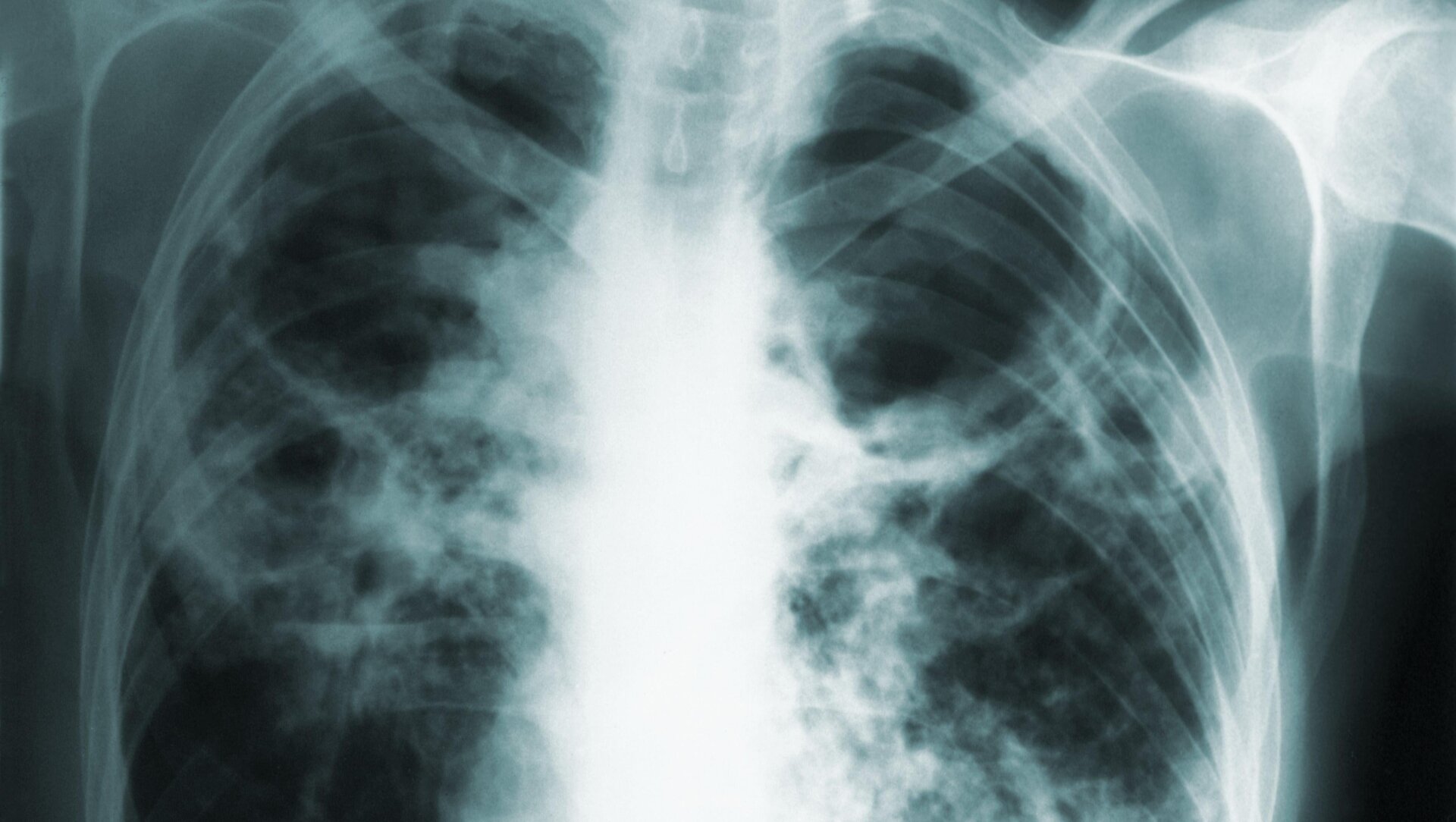 A chest X-ray of a tuberculosis patient.