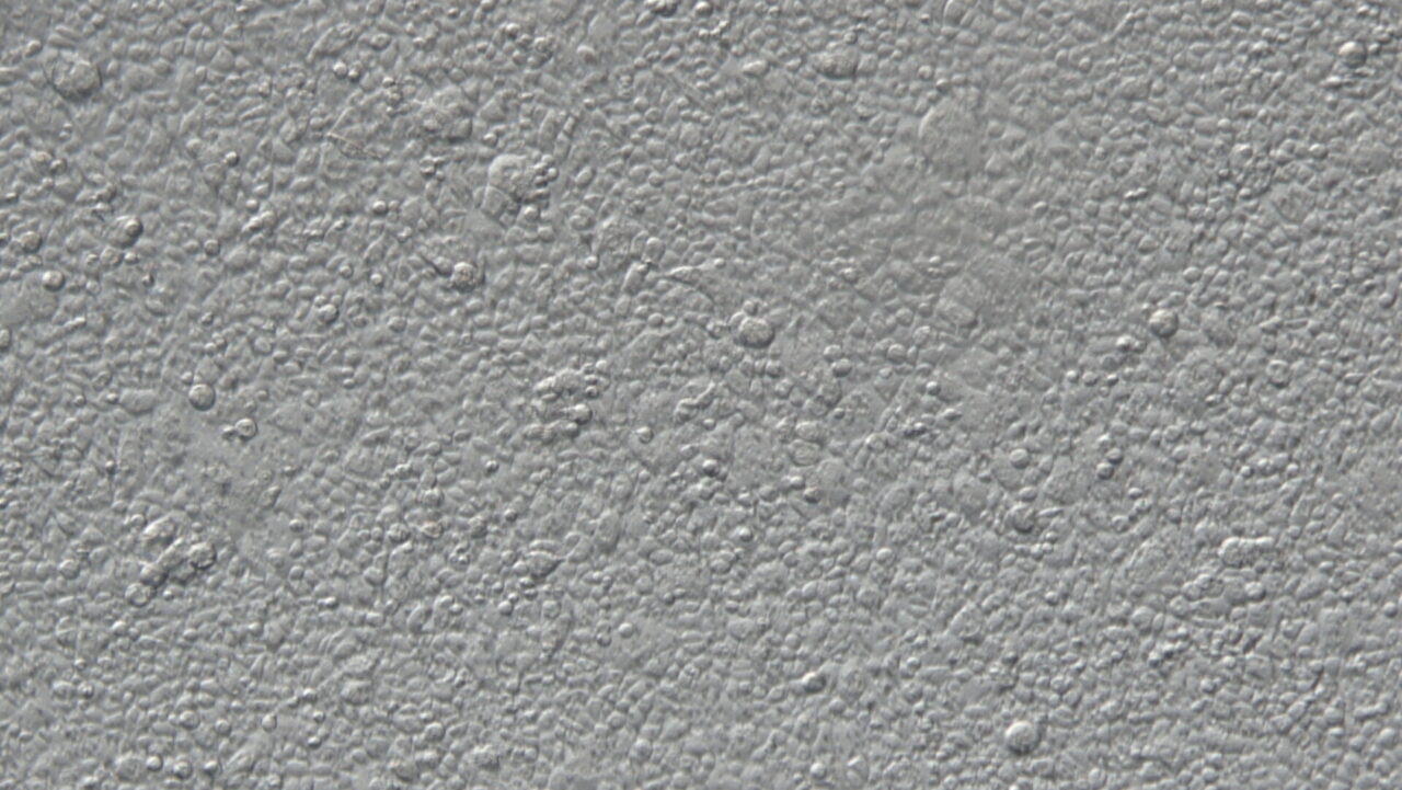 1. First Calec Patient's Stem Cells In Culture. Credit Mass Eye And Ear