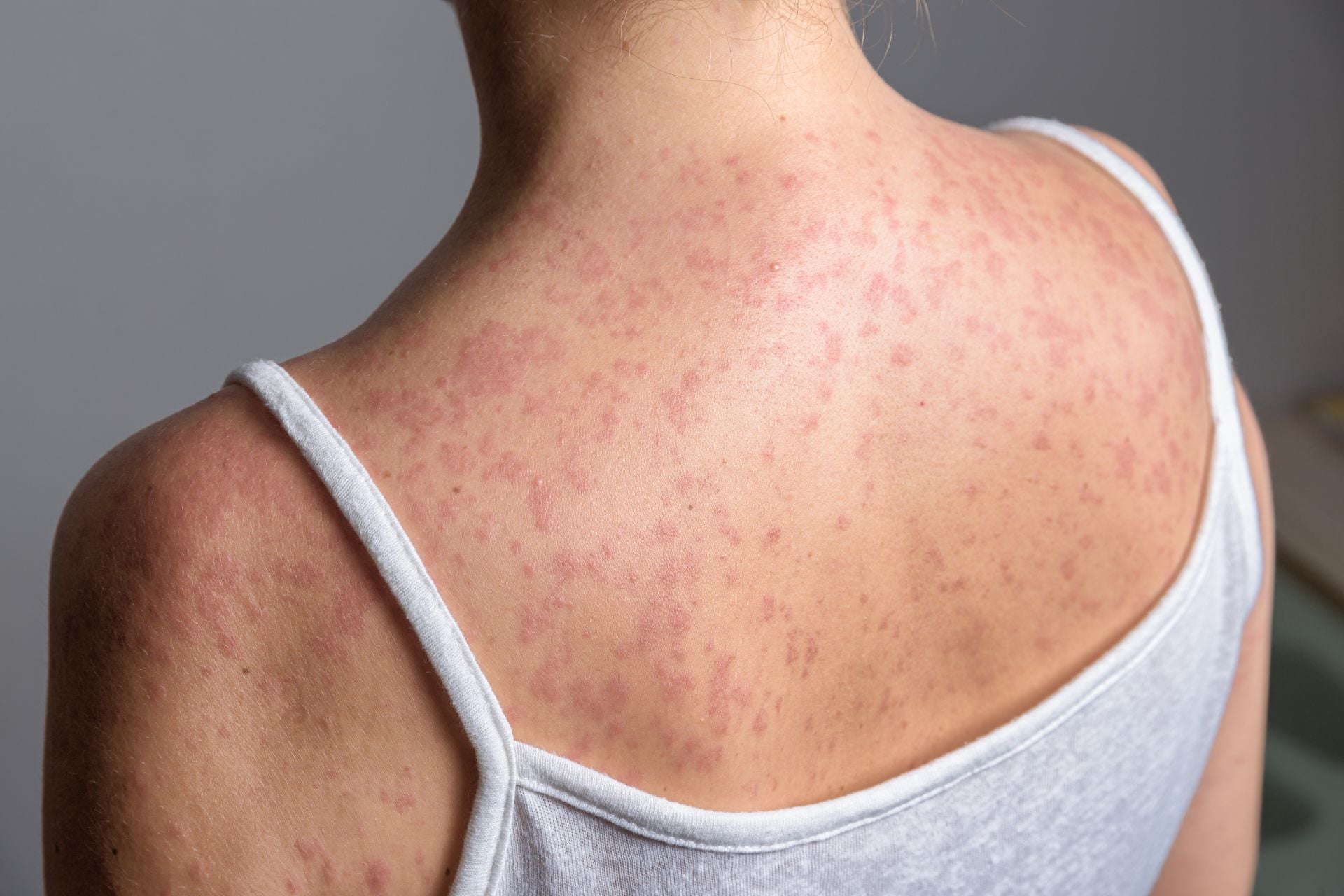 A woman with a rash caused by measles infection.