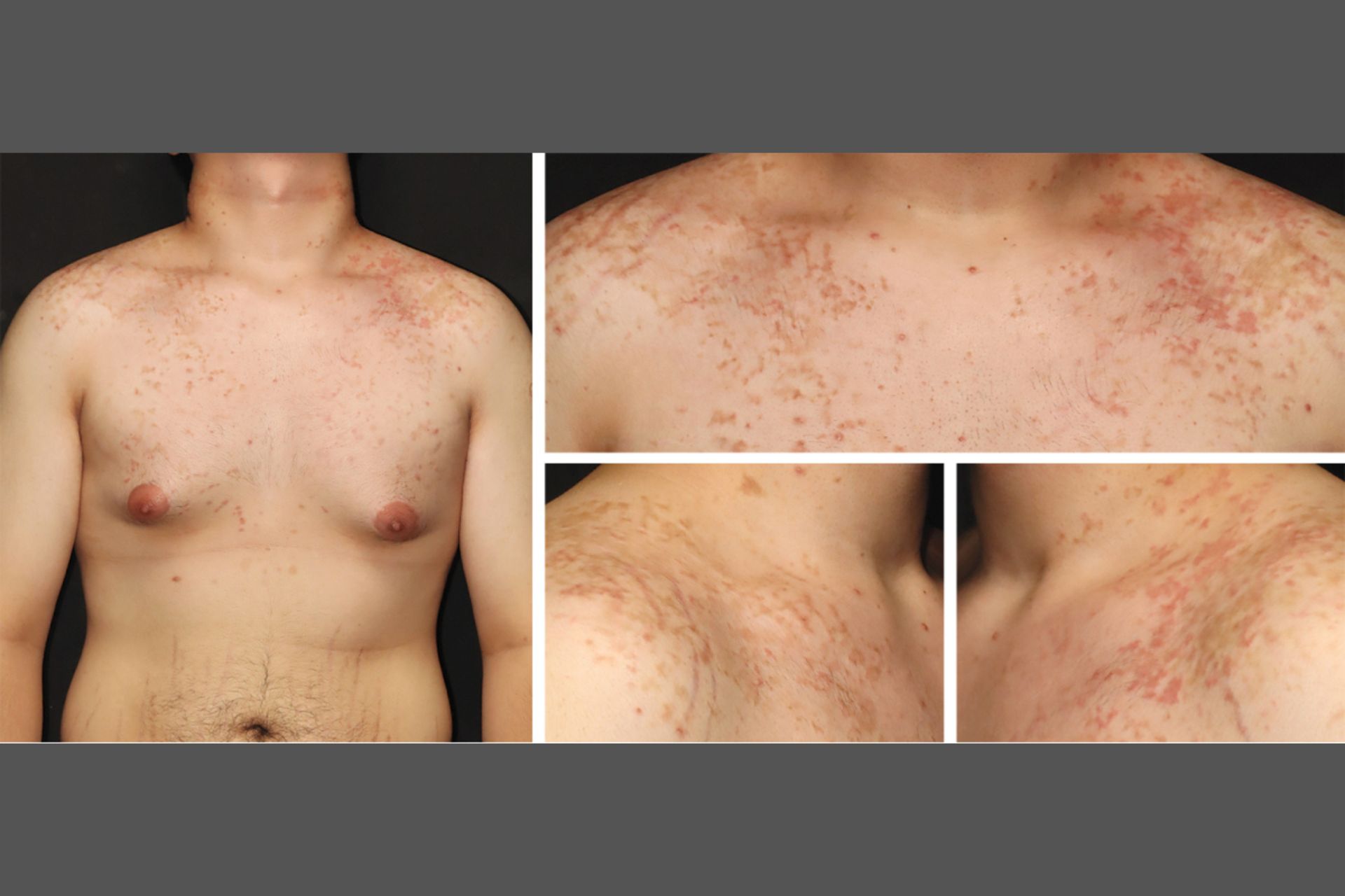 The man's prurigo pigmentosa; aka keto rash.