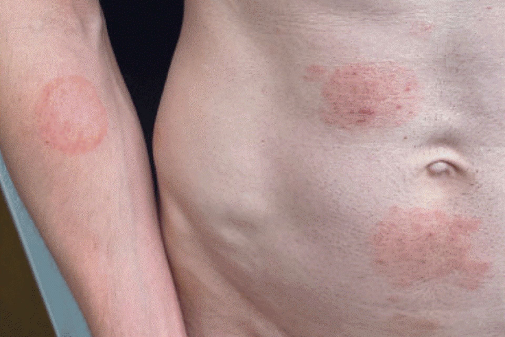 A patient with ringworm caused by TMVII.