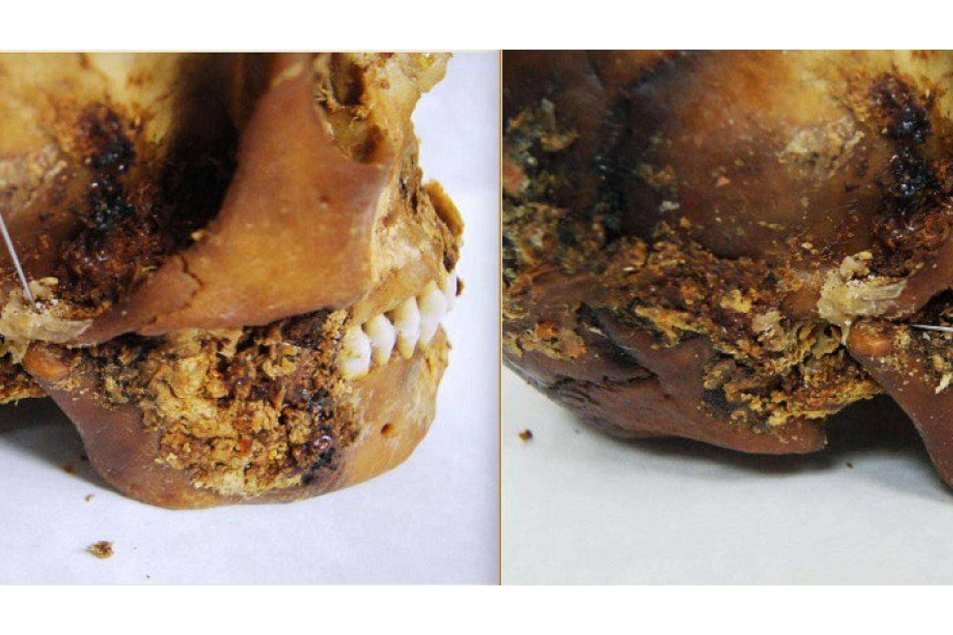 Researchers found evidence of ancient jaw surgery from CT scans of a 2,500-year-old mummified skull.