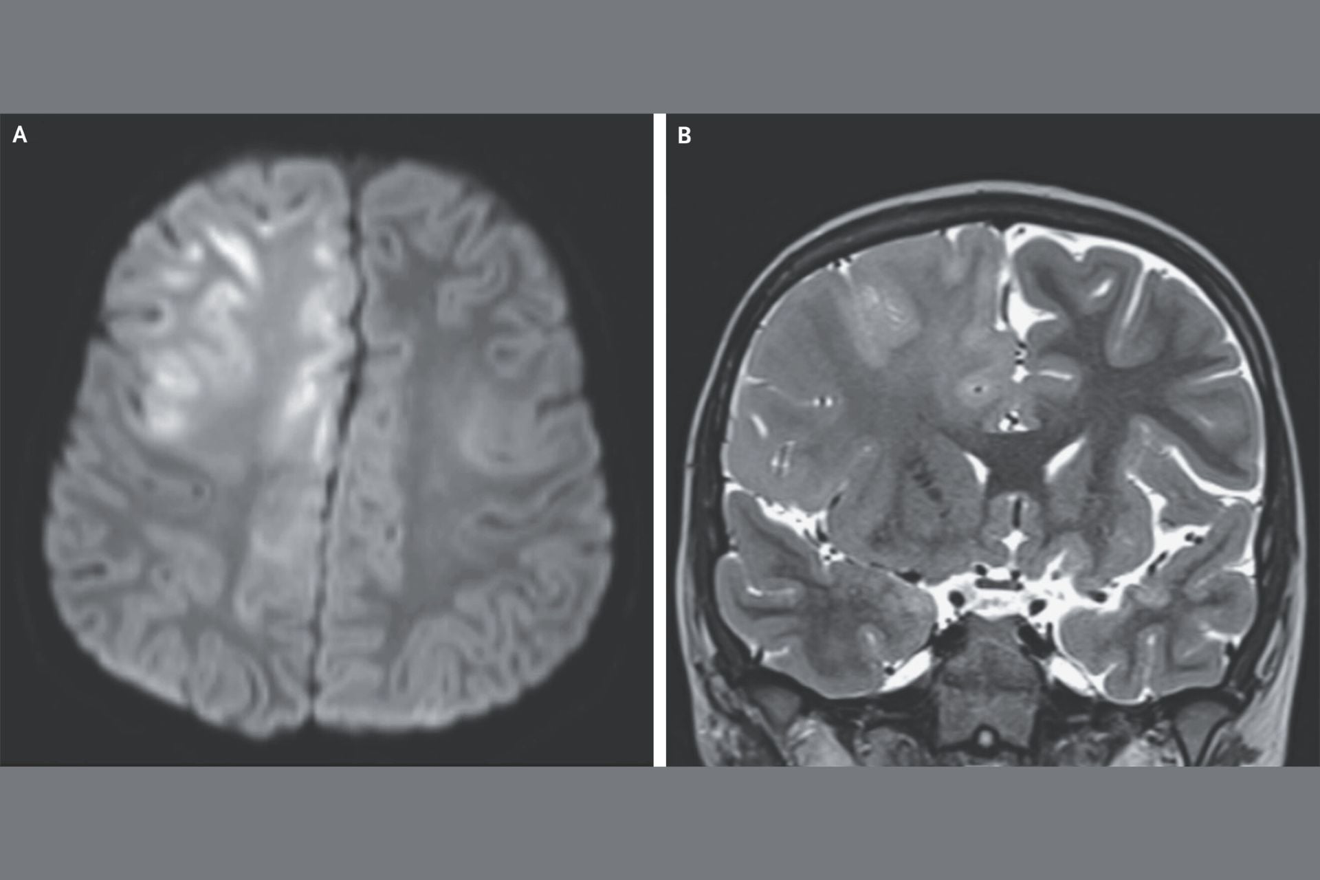 A MRI scan of a 7-year-old boy with SSPE.