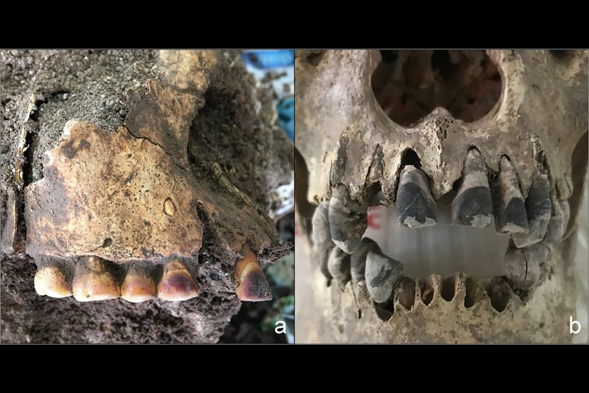 A comparison of dental residue possibly resulting from different practices: betel nut chewing in greater Southeast Asia (left) and tooth blackening in Vietnam (right).