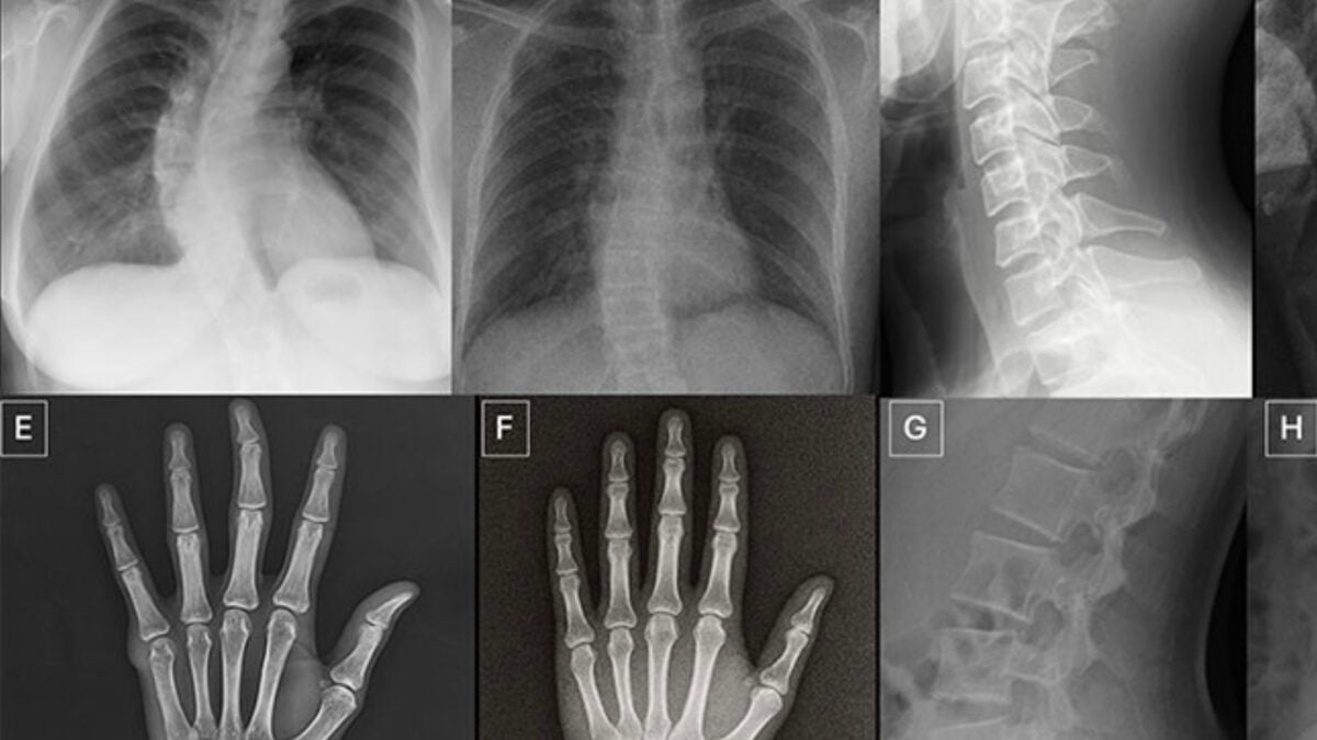 Doctors Struggle to Spot AI-Generated X-Rays, Raising Scam Risks