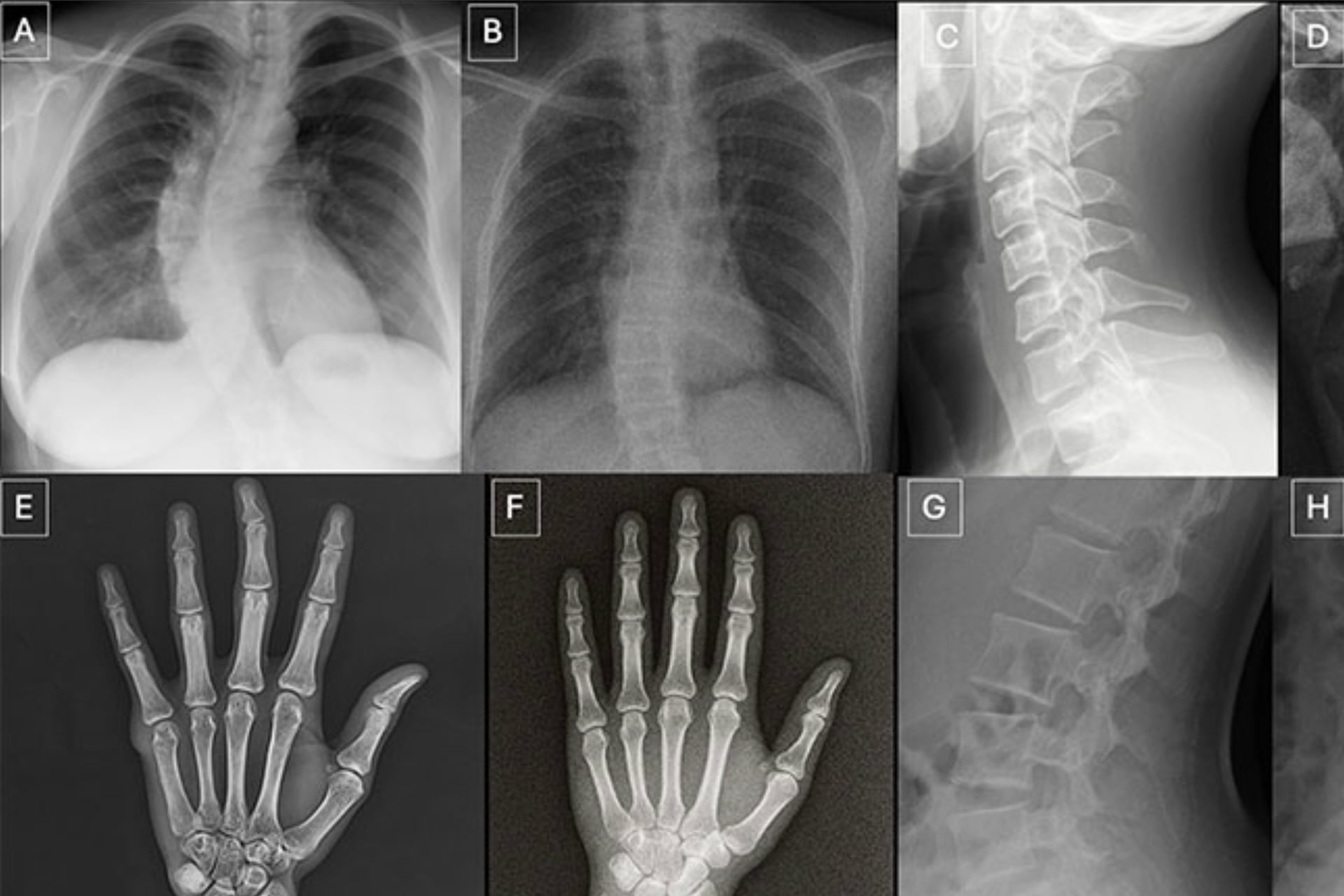 Above: Anatomy-matched real and ChatGPT-4o-generated fake X-rays. A, C, E and G are real. The others a fakes.