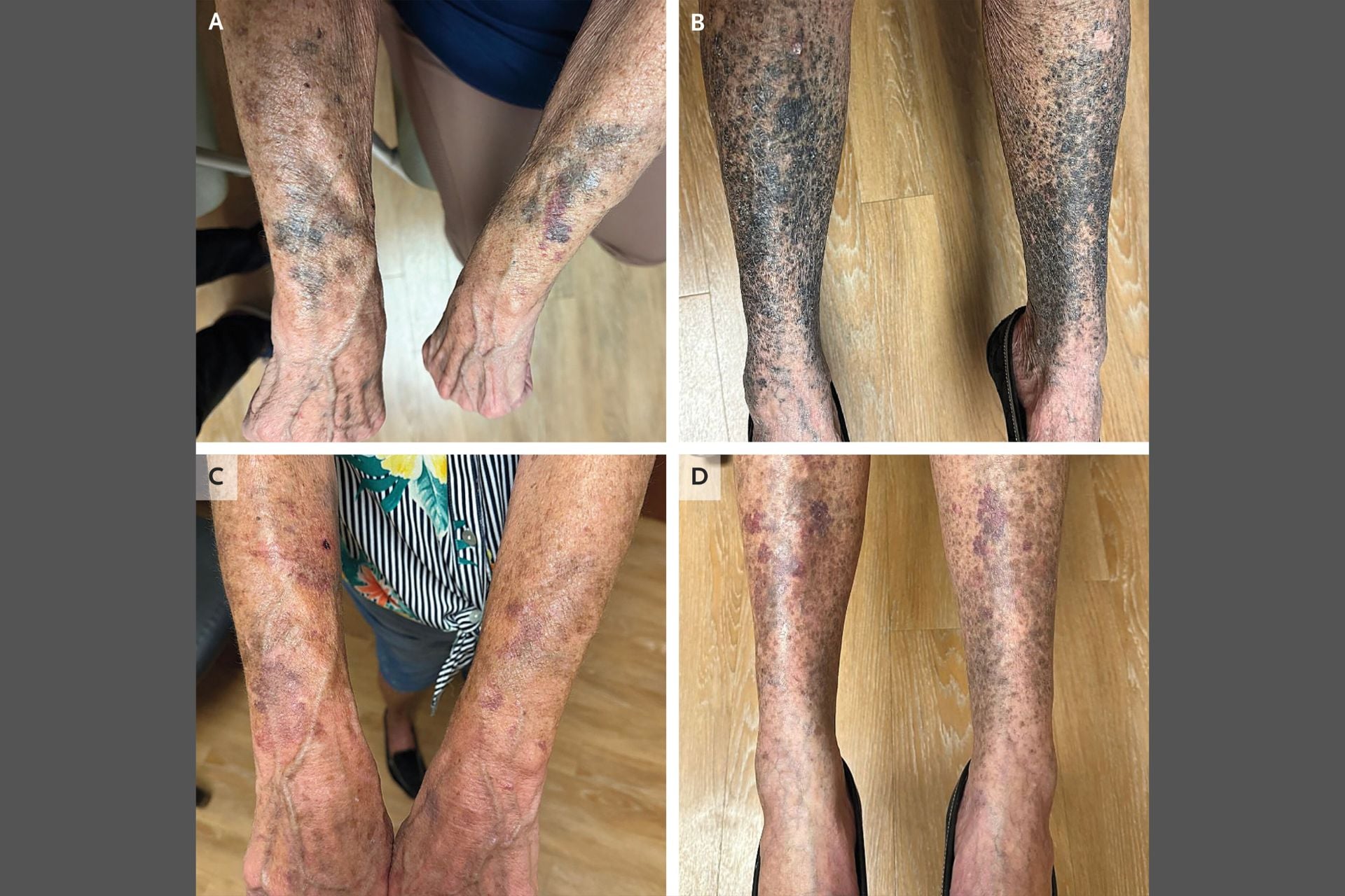 Above, the woman's arms and legs six weeks after taking minocycline. Below, her limbs six months after stopping treatment.