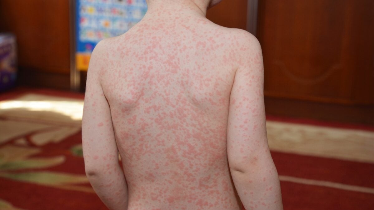 That Teenage Bout of Mono May Have a Troubling Second Act