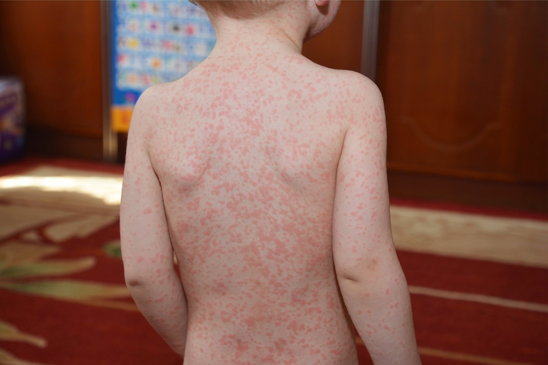 A child with a rash caused by mono.