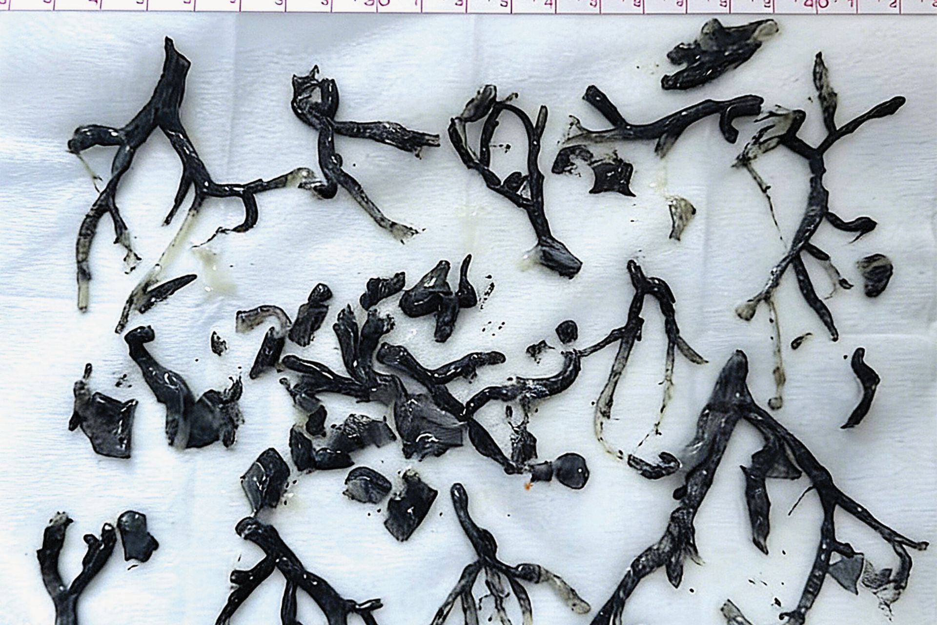 The man's bronchial casts extracted by the doctors.