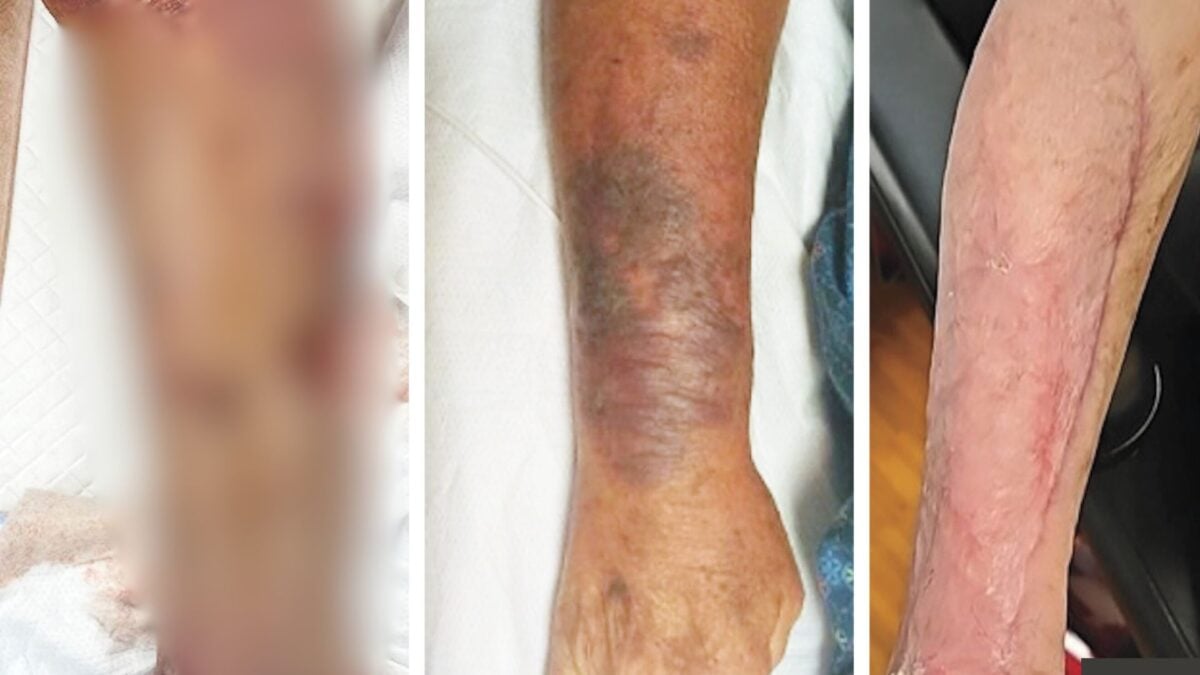 This Is What a Leg Ravaged by 'Flesh-Eating' Bacteria Looks Like