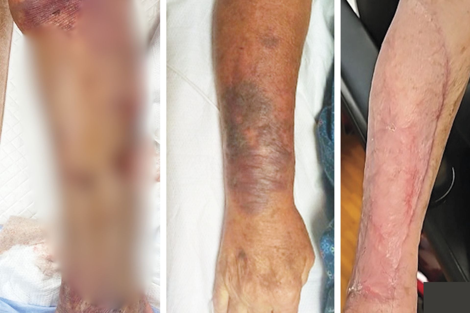Panel A shows a blurred image of the man's infected right leg, while panels B and C show the man's affected right arm before and after skin graft treatment.