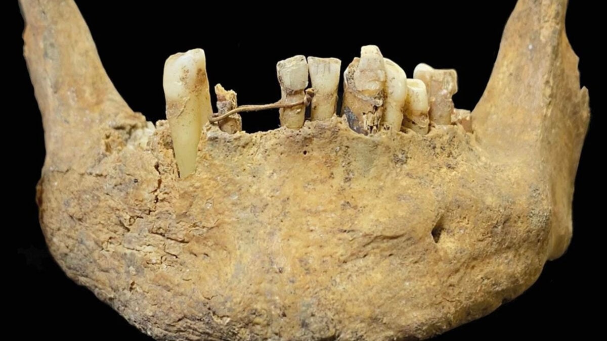 Archaeologists Unearth &lsquo;Advanced&rsquo; Gold Dental Bridge in Medieval Scottish Grave