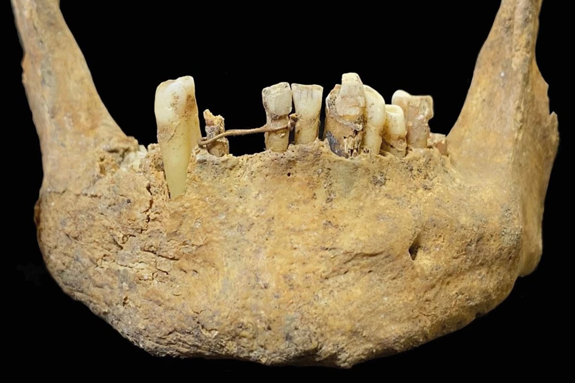 Above, a gold wire ligature wraps around two incisors, like a modern ‘dental bridge,’ on a jawbone found buried in the parish church of St Nicholas in Aberdeen, Scotland.