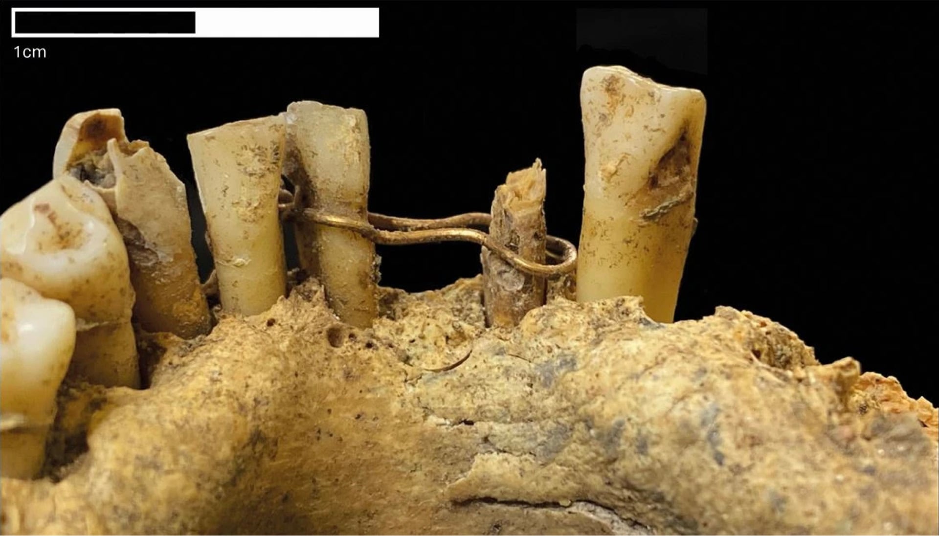 Gold Ligature medieval dentistry back view