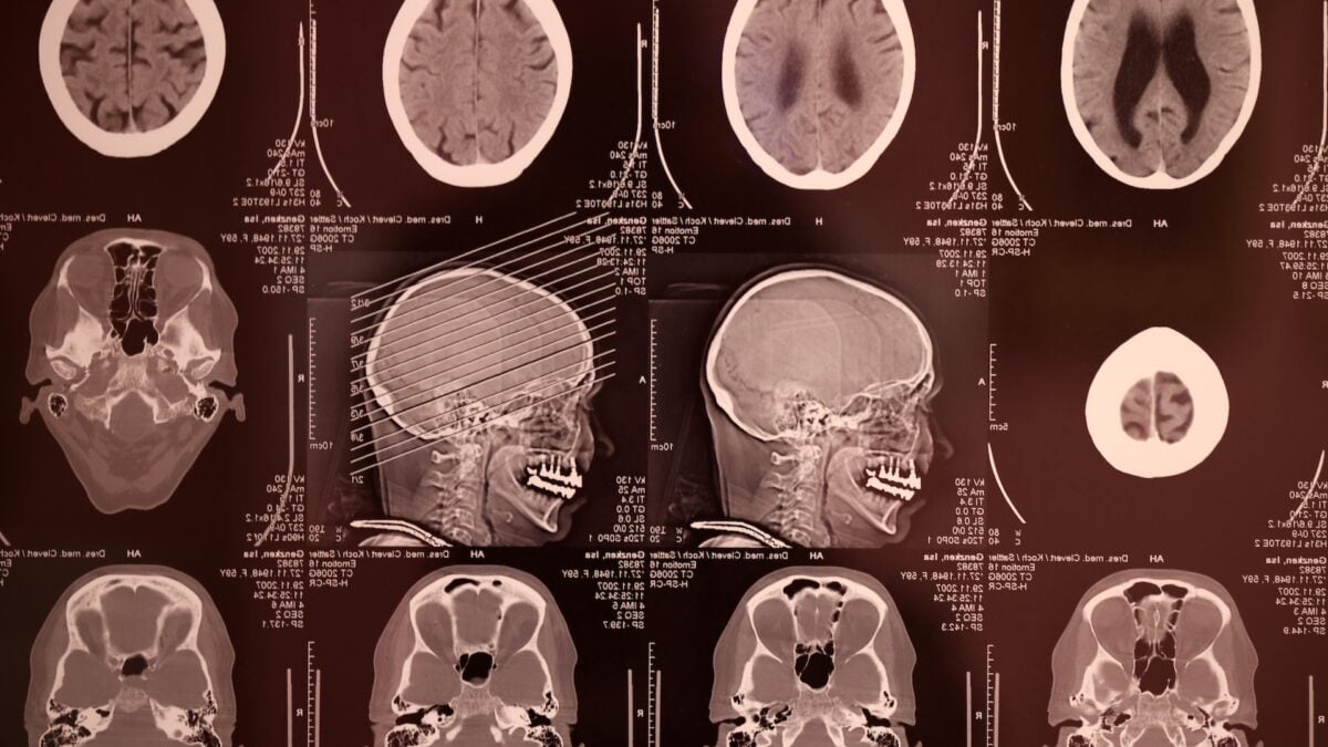 Meta debuts non-invasive Brain2Qwerty v2 decoder